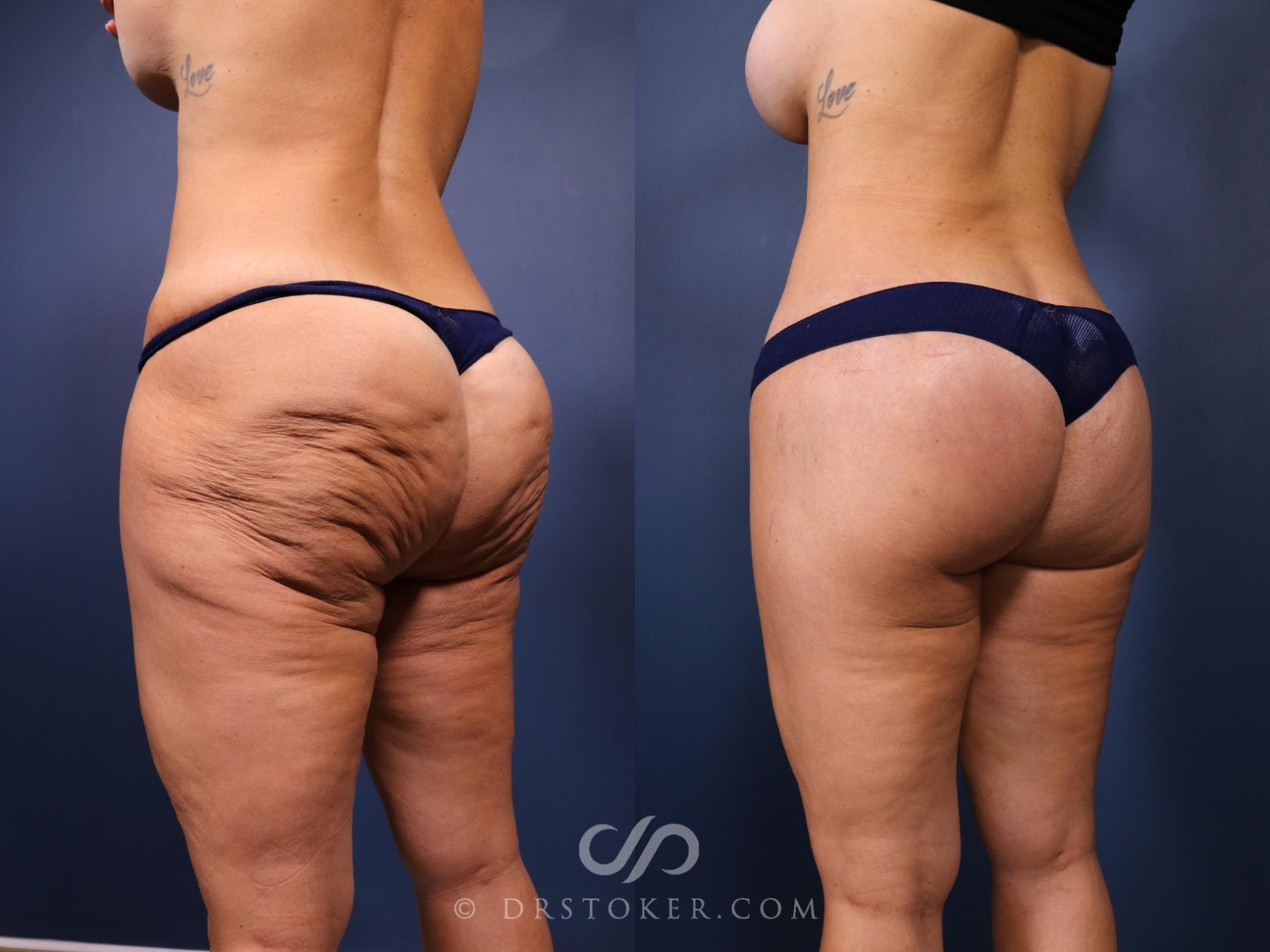 Before & After Bikini Body Lift ™ Case 2526 Left Oblique View in Los Angeles, CA