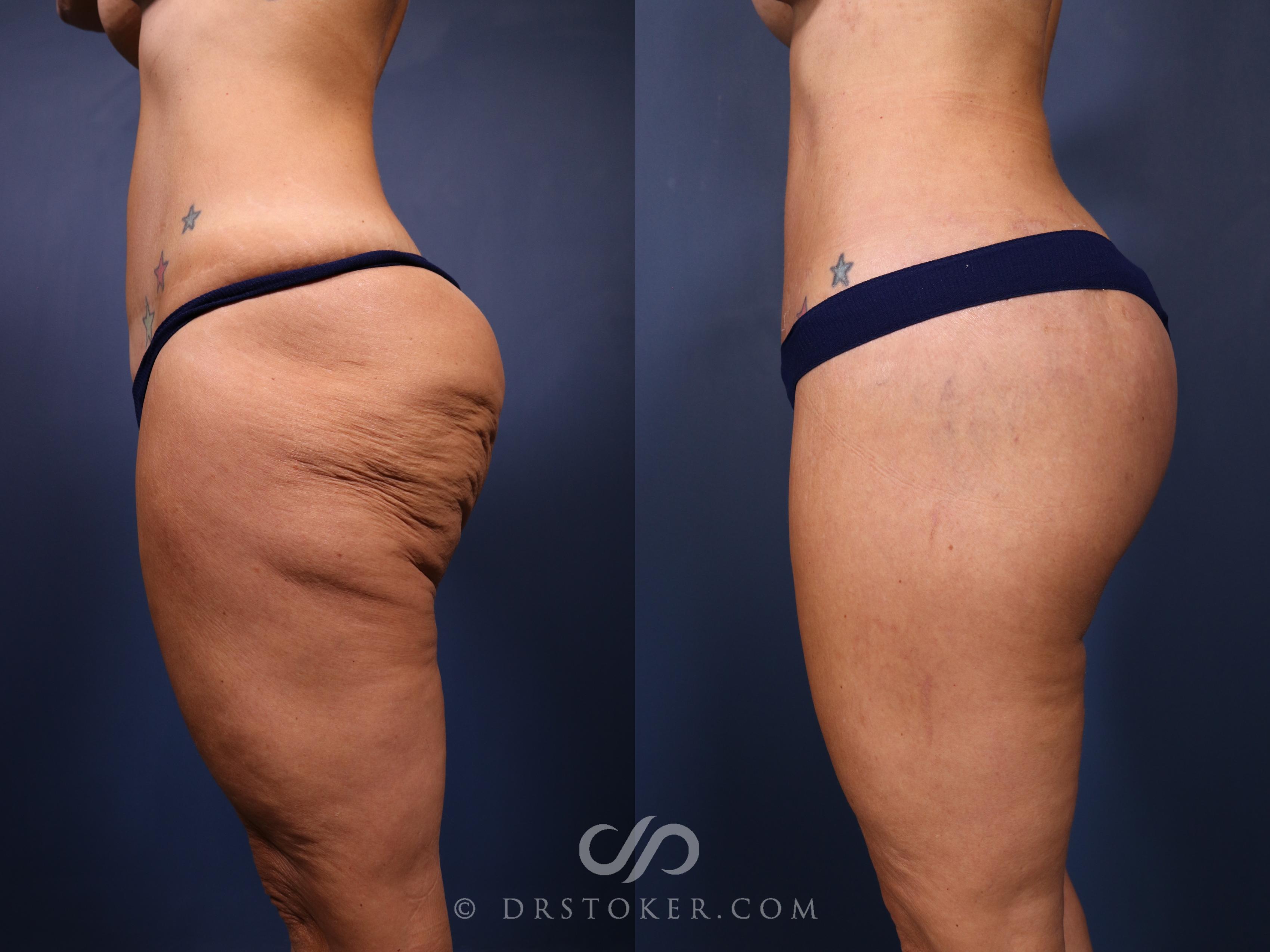 Before & After Bikini Body Lift ™ Case 2526 Left Side View in Los Angeles, CA