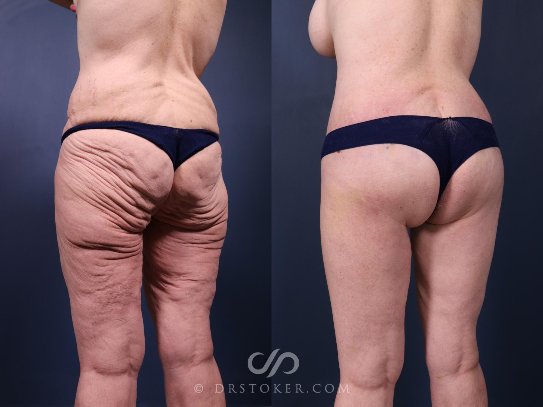 Before & After Bikini Body Lift ™ Case 2527 Back View in Los Angeles, CA