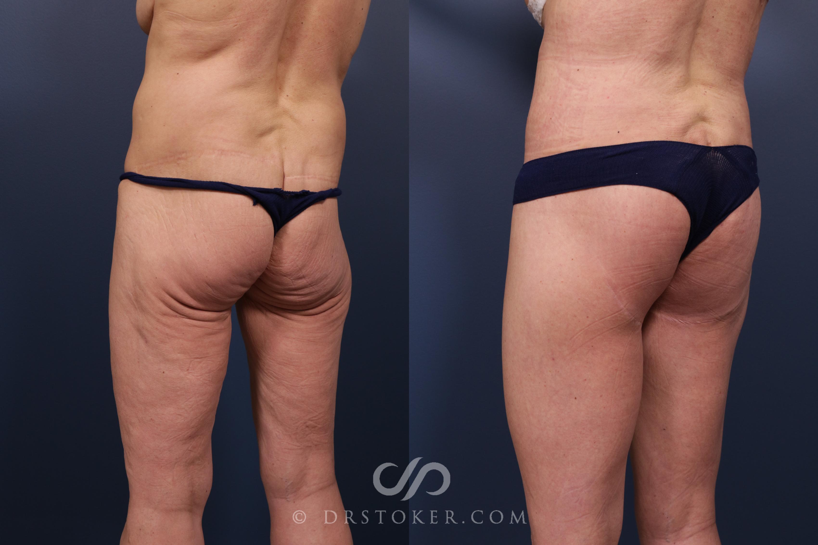 Before & After Bikini Body Lift ™ Case 2529 Left Oblique View in Los Angeles, CA