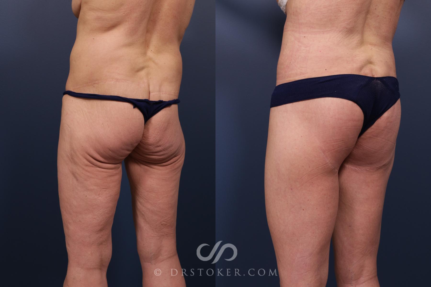 Before & After Bikini Body Lift ™ Case 2529 Left Oblique View in Los Angeles, CA