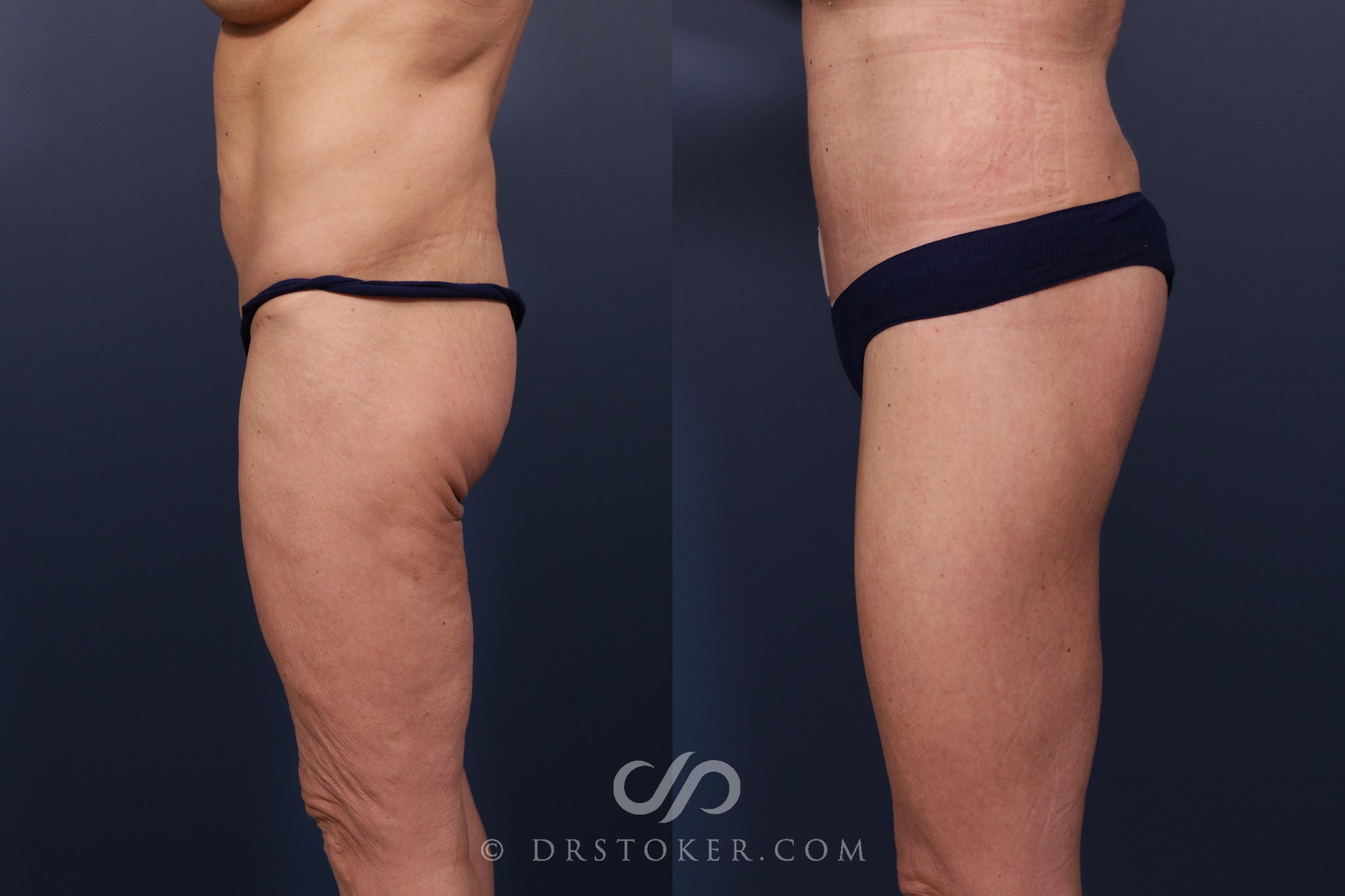 Before & After Bikini Body Lift ™ Case 2529 Left Side View in Los Angeles, CA