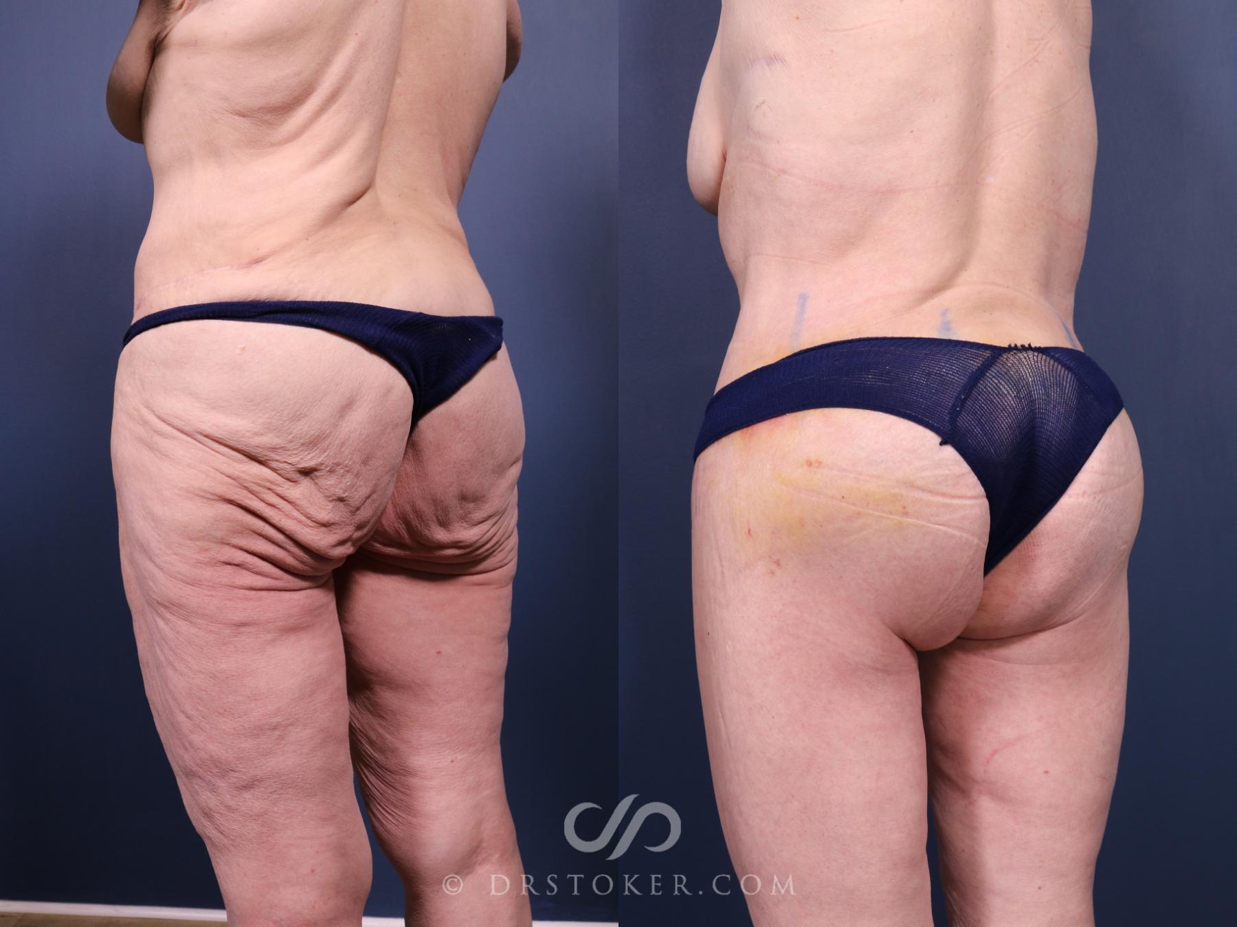 Before & After Bikini Body Lift ™ Case 2530 Left Oblique View in Los Angeles, CA