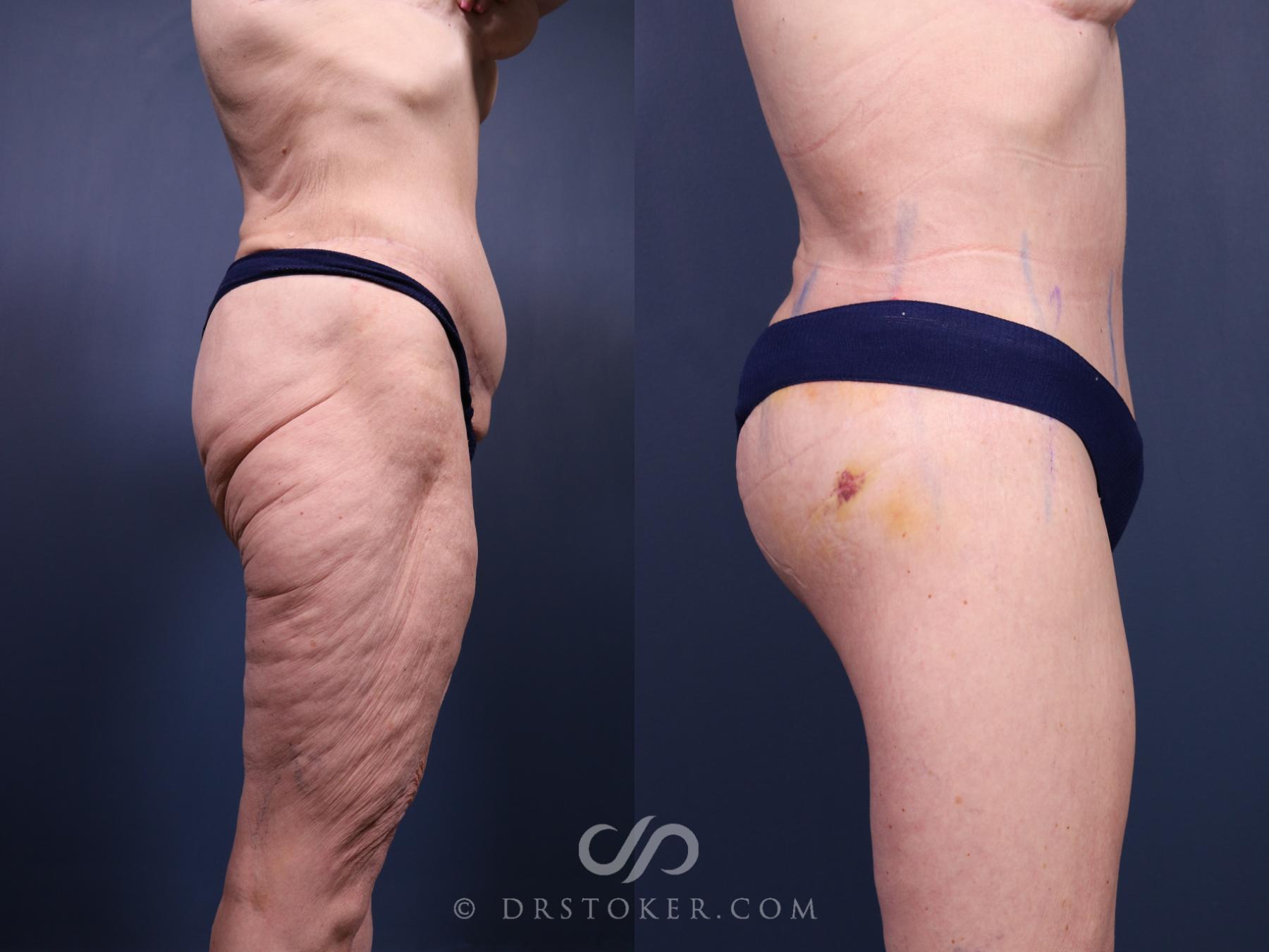 Before & After Bikini Body Lift ™ Case 2530 Right Side View in Los Angeles, CA