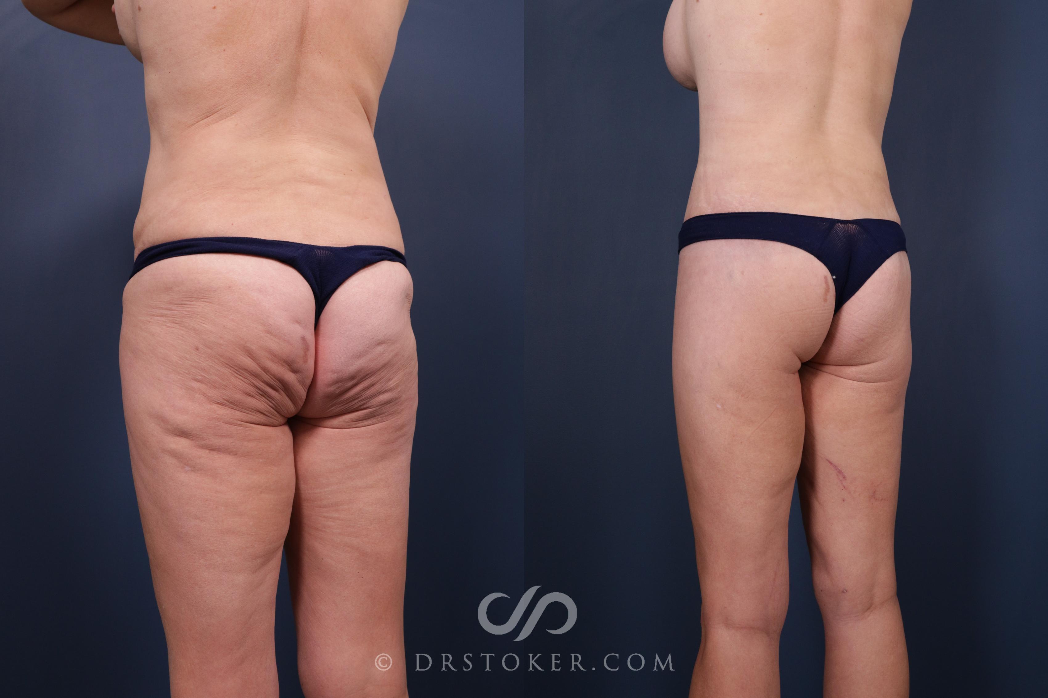 Before & After Bikini Body Lift ™ Case 2532 Left Oblique View in Los Angeles, CA