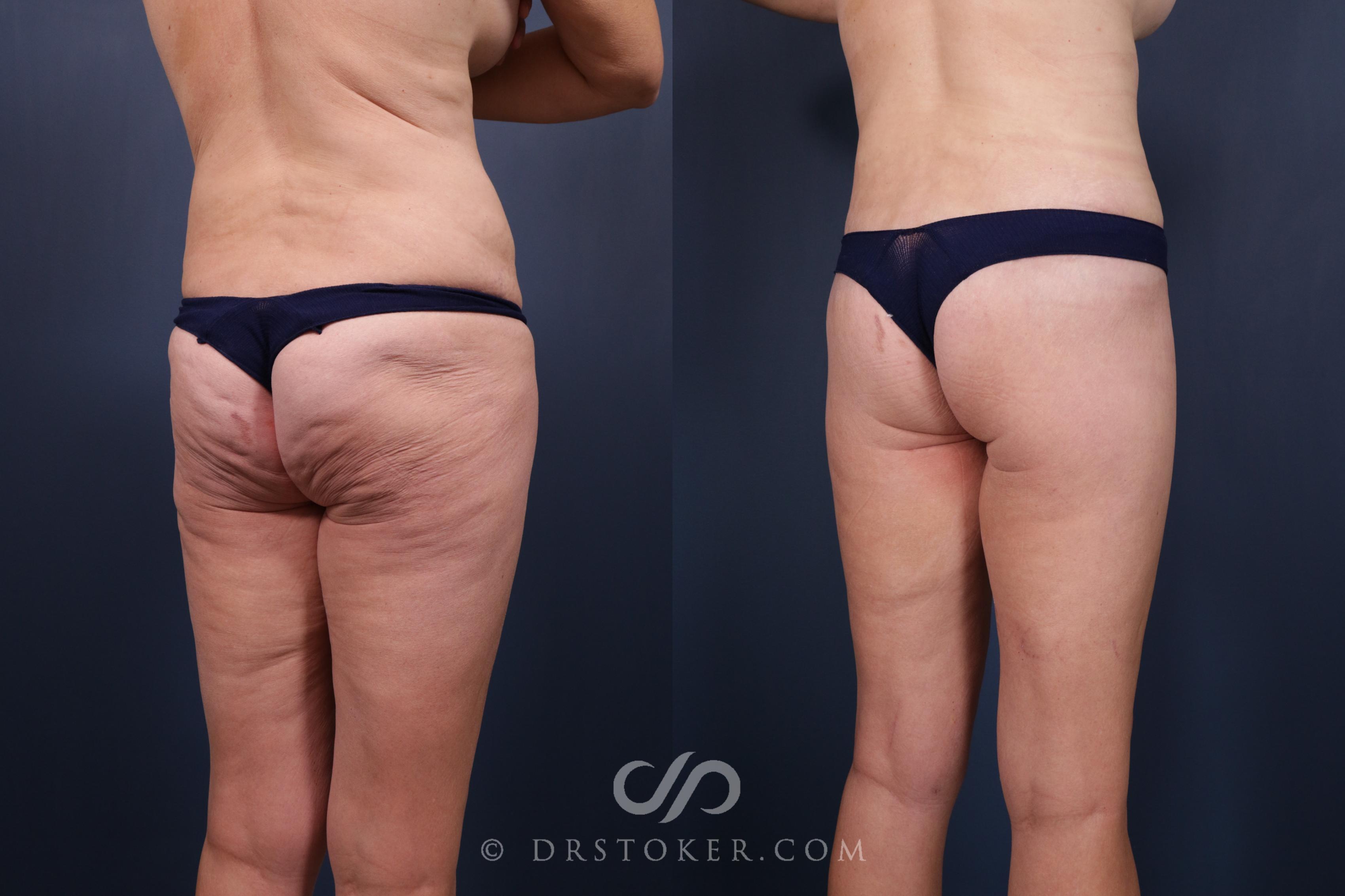 Before & After Bikini Body Lift ™ Case 2532 Right Oblique View in Los Angeles, CA