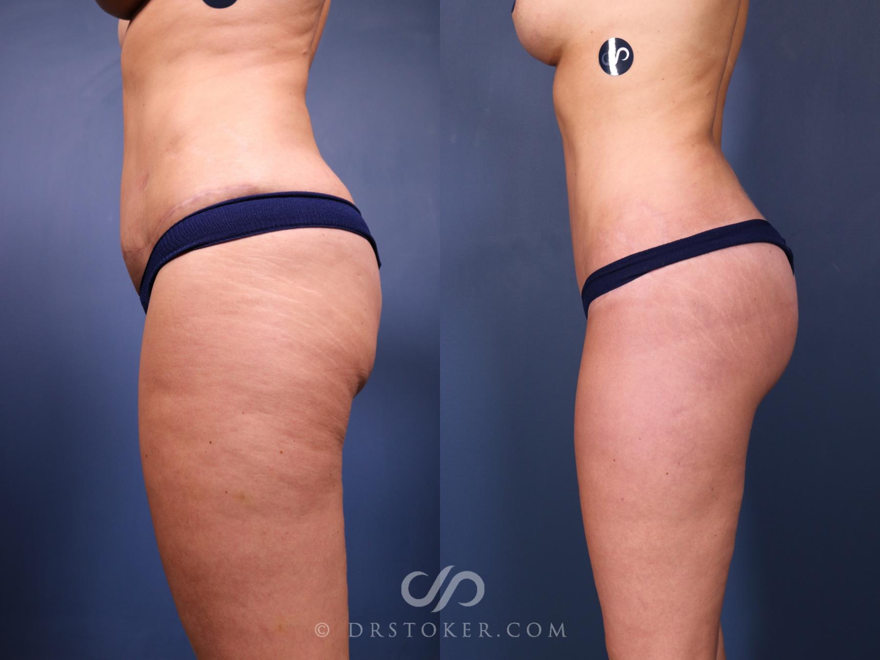 Before & After Bikini Body Lift ™ Case 2536 Left Side View in Los Angeles, CA