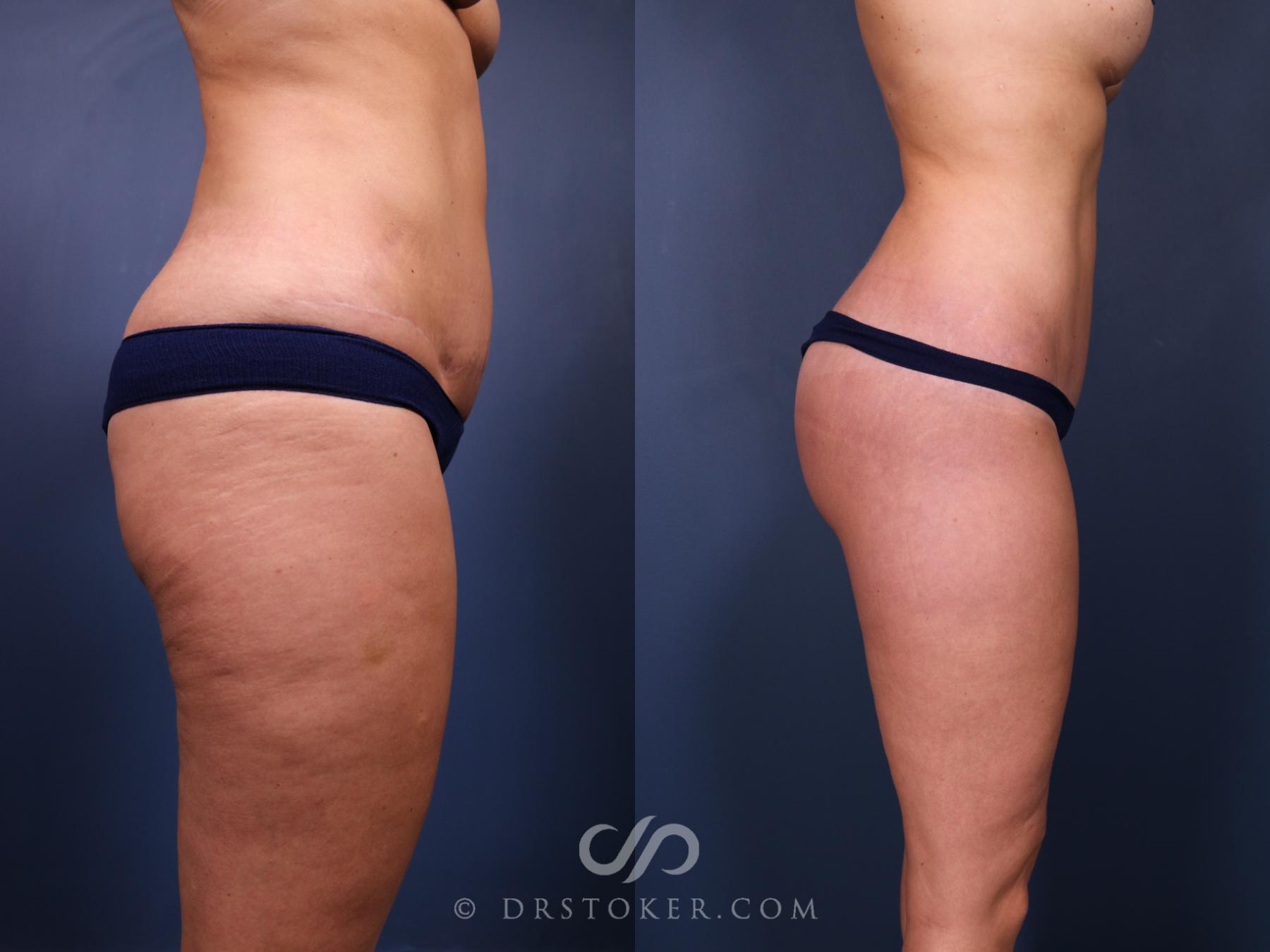 Before & After Bikini Body Lift ™ Case 2536 Right Side View in Los Angeles, CA
