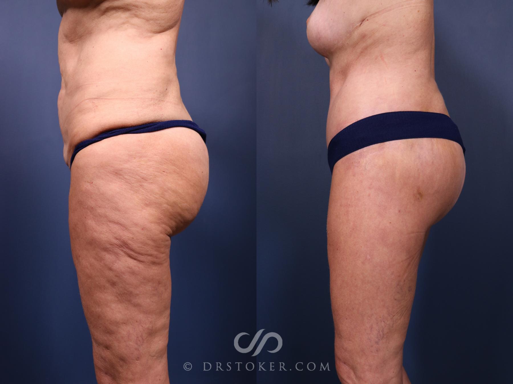 Before & After Bikini Body Lift ™ Case 2539 Left Side View in Los Angeles, CA