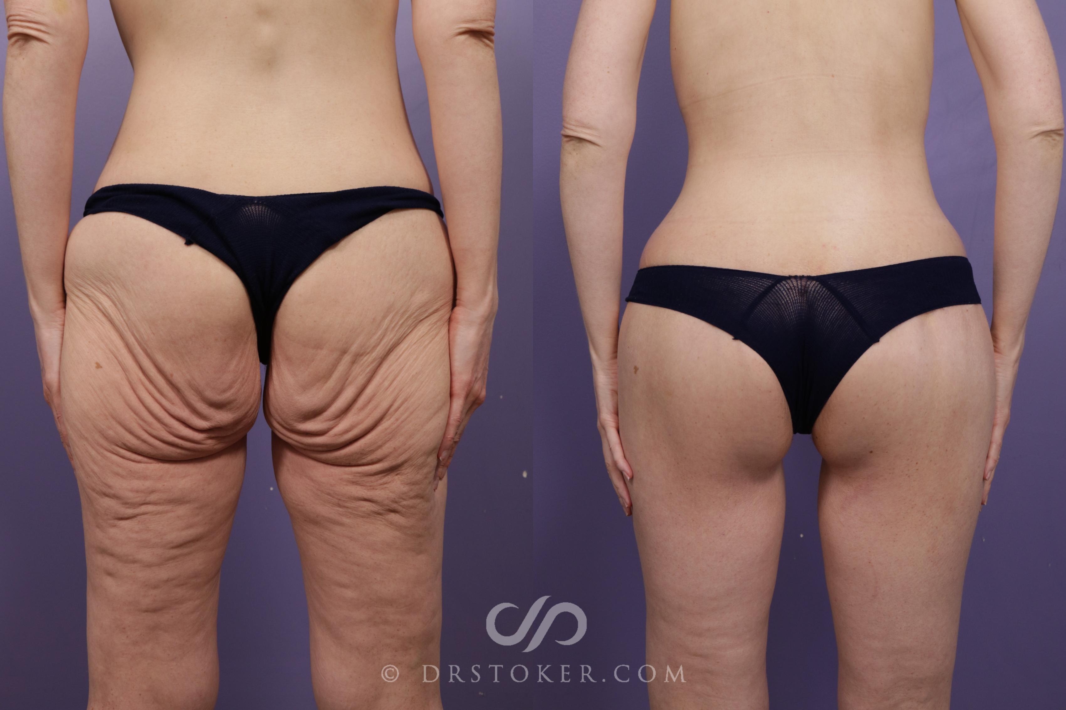 Before & After Bikini Body Lift ™ Case 2544 Back View in Los Angeles, CA