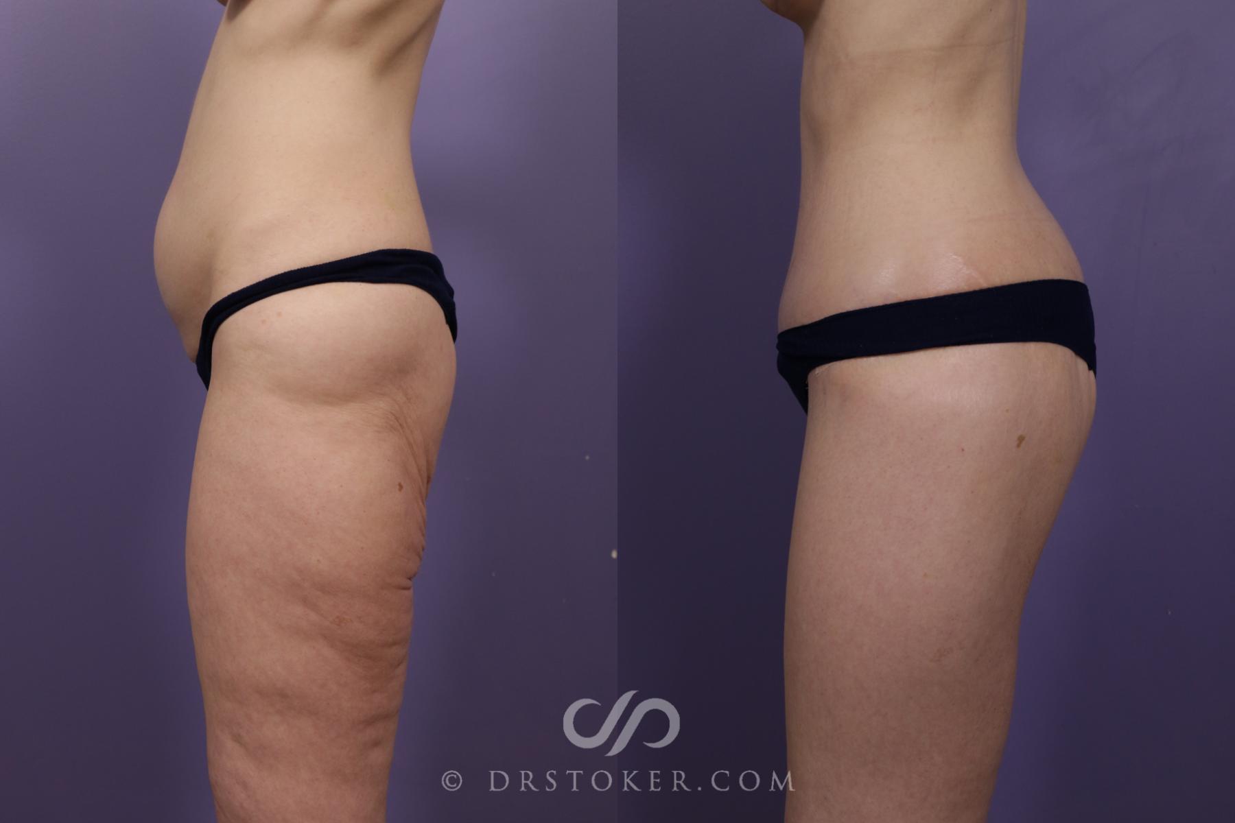 Before & After Bikini Body Lift ™ Case 2544 Left Side View in Los Angeles, CA