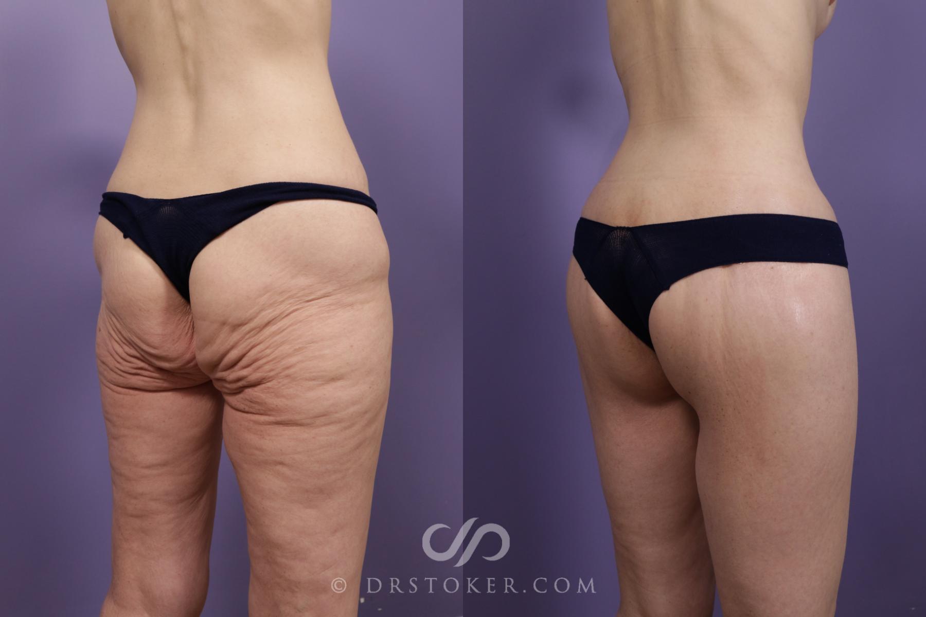 Before & After Bikini Body Lift ™ Case 2544 Right Oblique View in Los Angeles, CA