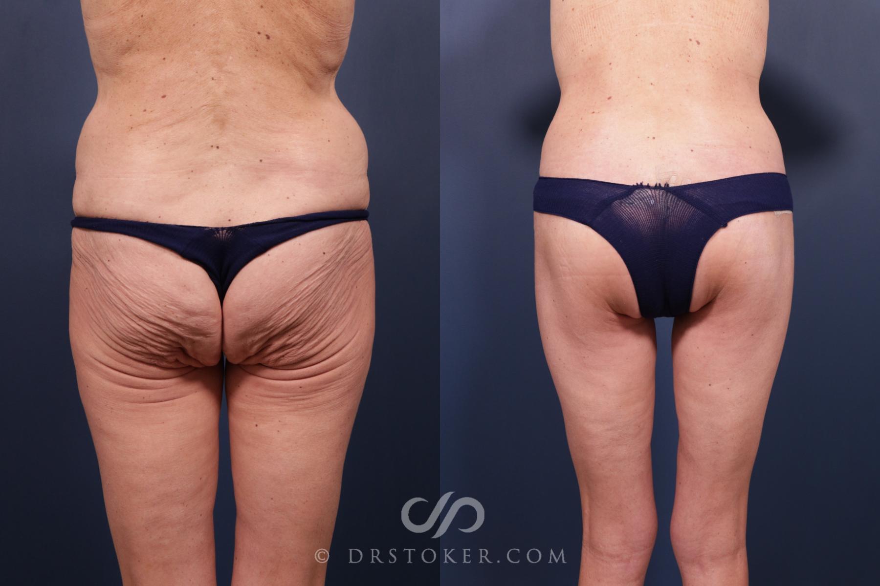Before & After Bikini Body Lift ™ Case 2547 Back View in Los Angeles, CA