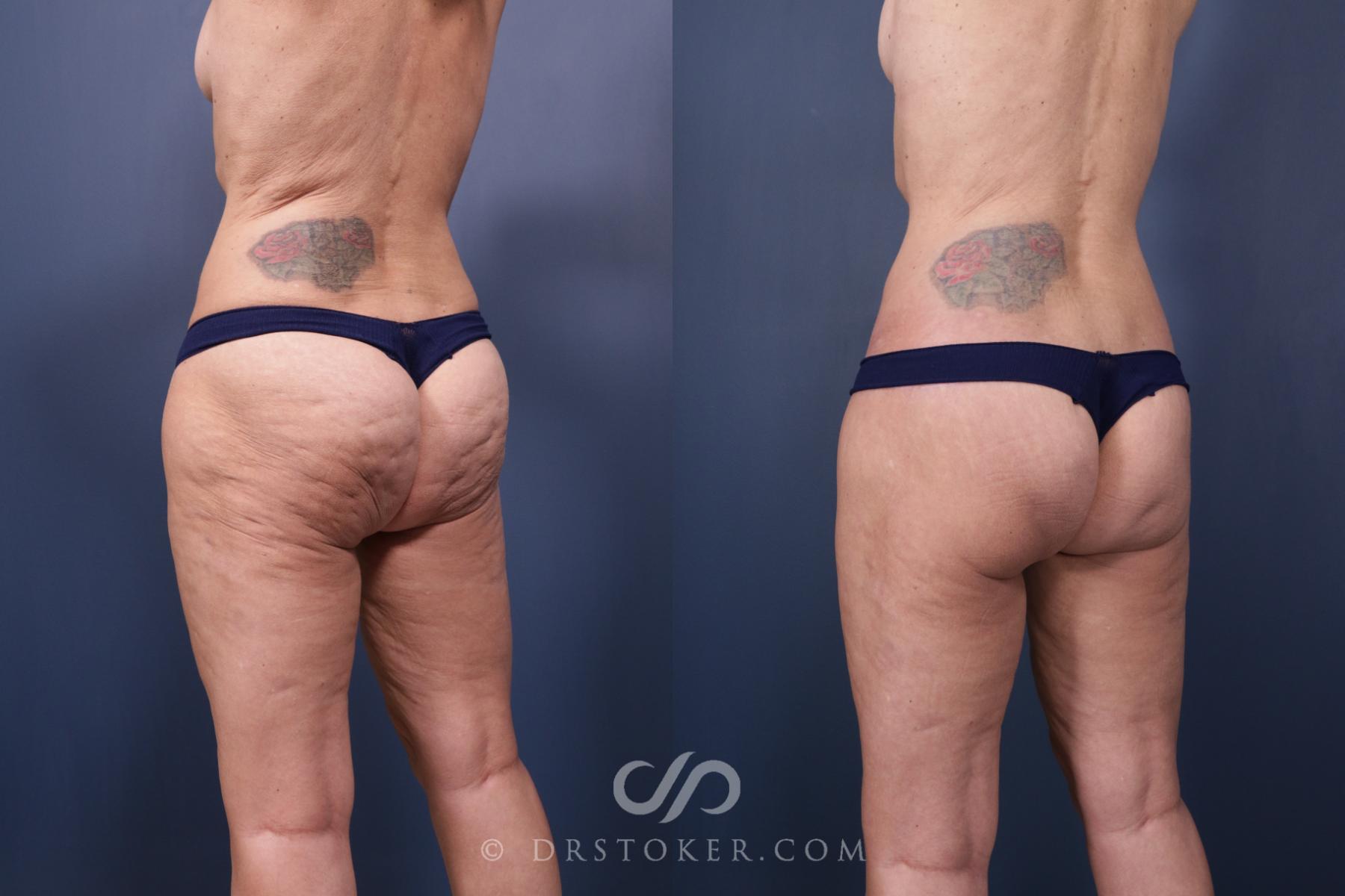 Before & After Bikini Body Lift ™ Case 2548 Left Oblique View in Los Angeles, CA