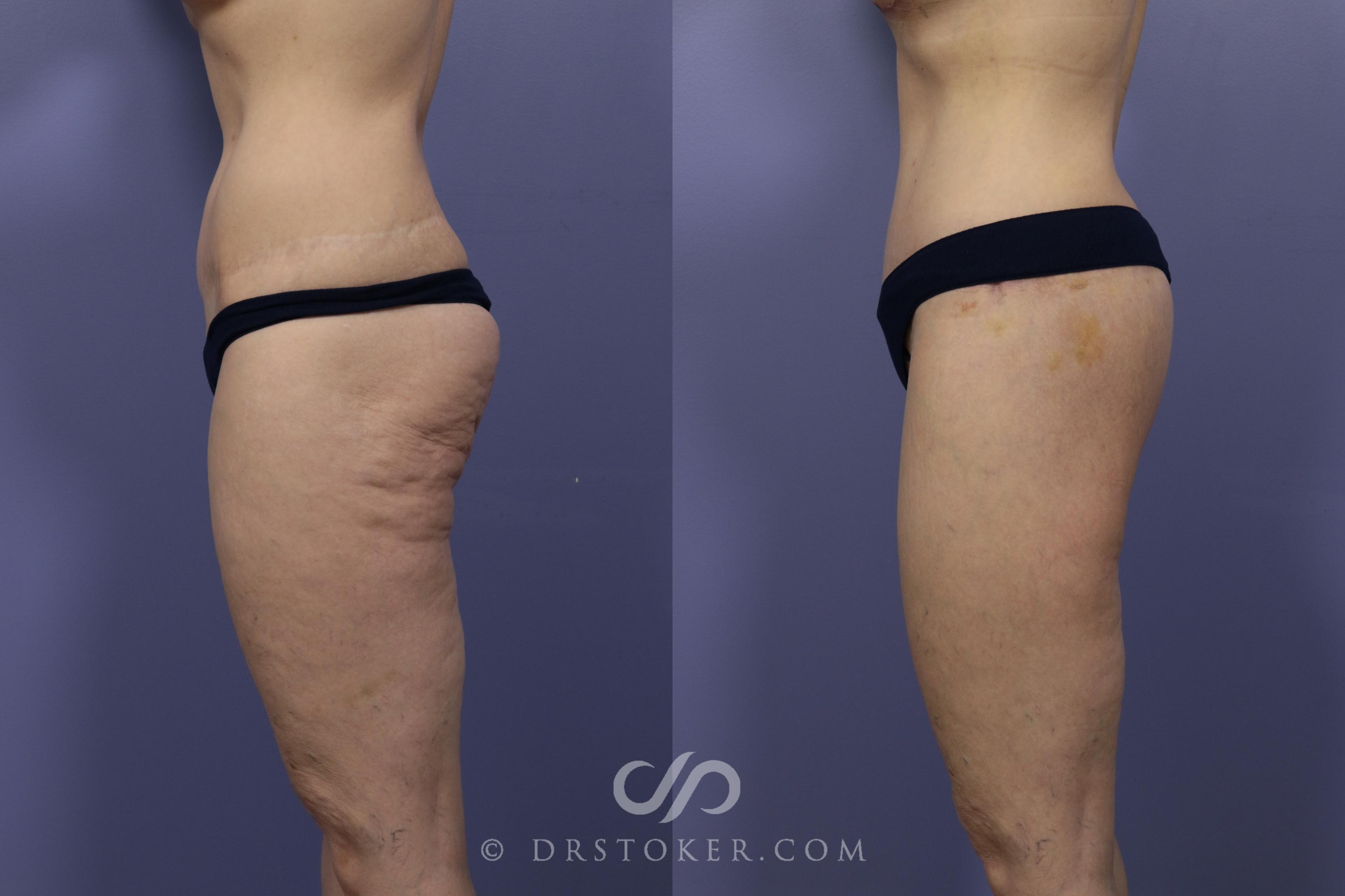 Before & After Bikini Body Lift ™ Case 2549 Left Side View in Los Angeles, CA
