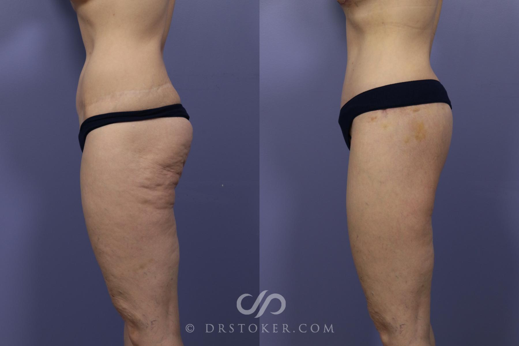 Before & After Bikini Body Lift ™ Case 2549 Left Side View in Los Angeles, CA
