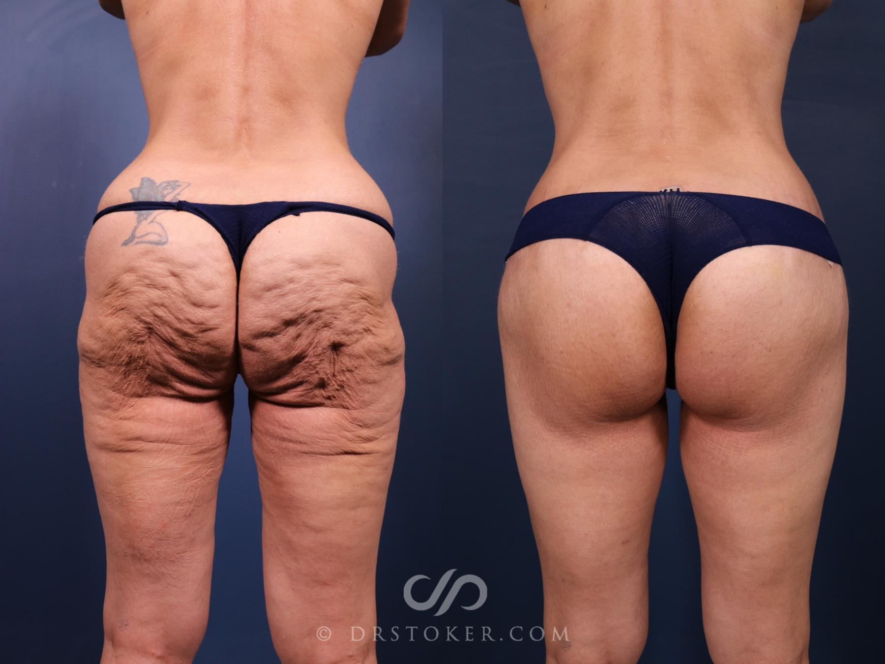 Before & After Bikini Body Lift ™ Case 2551 Back View in Los Angeles, CA