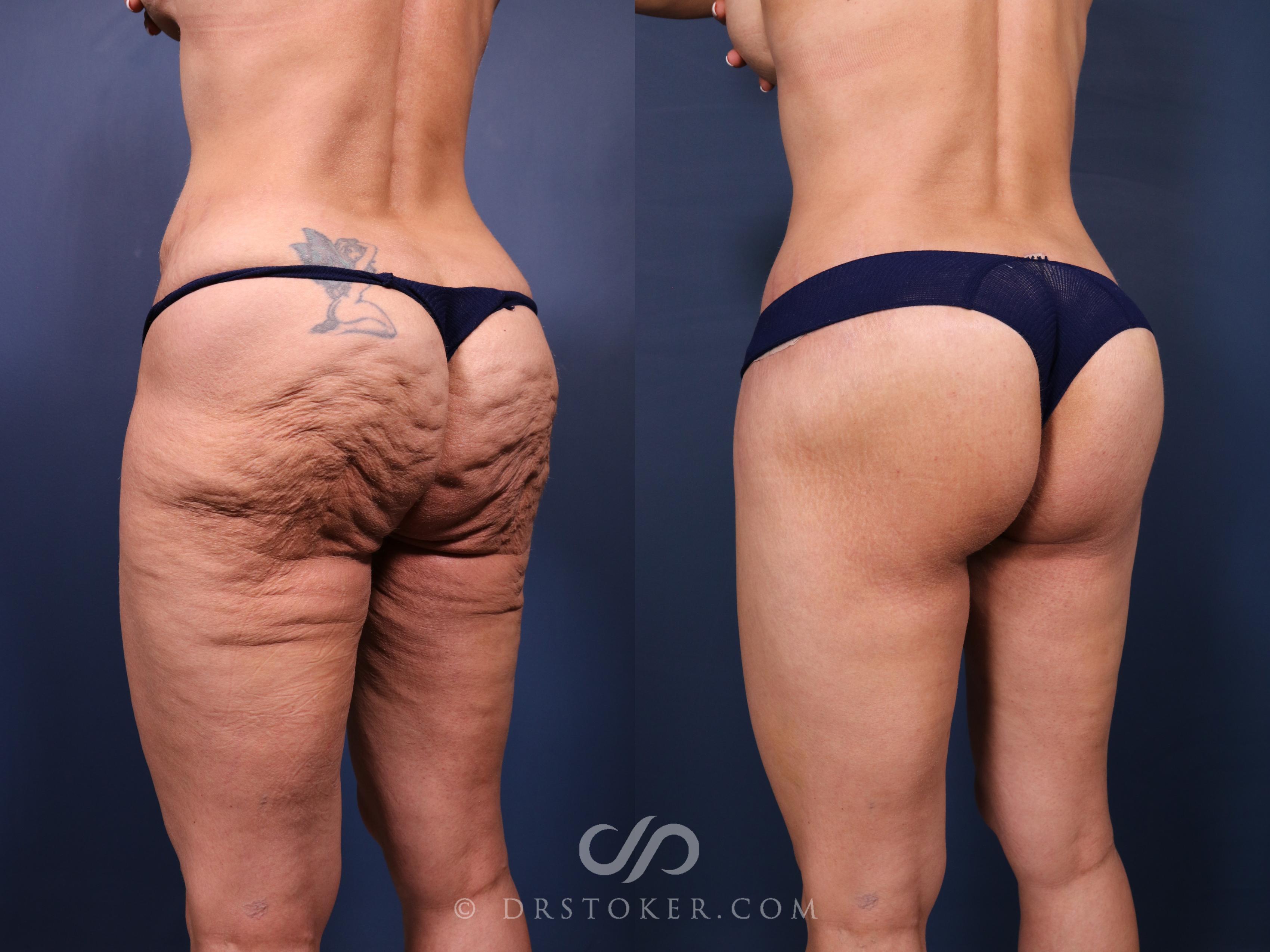 Before & After Bikini Body Lift ™ Case 2551 Left Oblique View in Los Angeles, CA