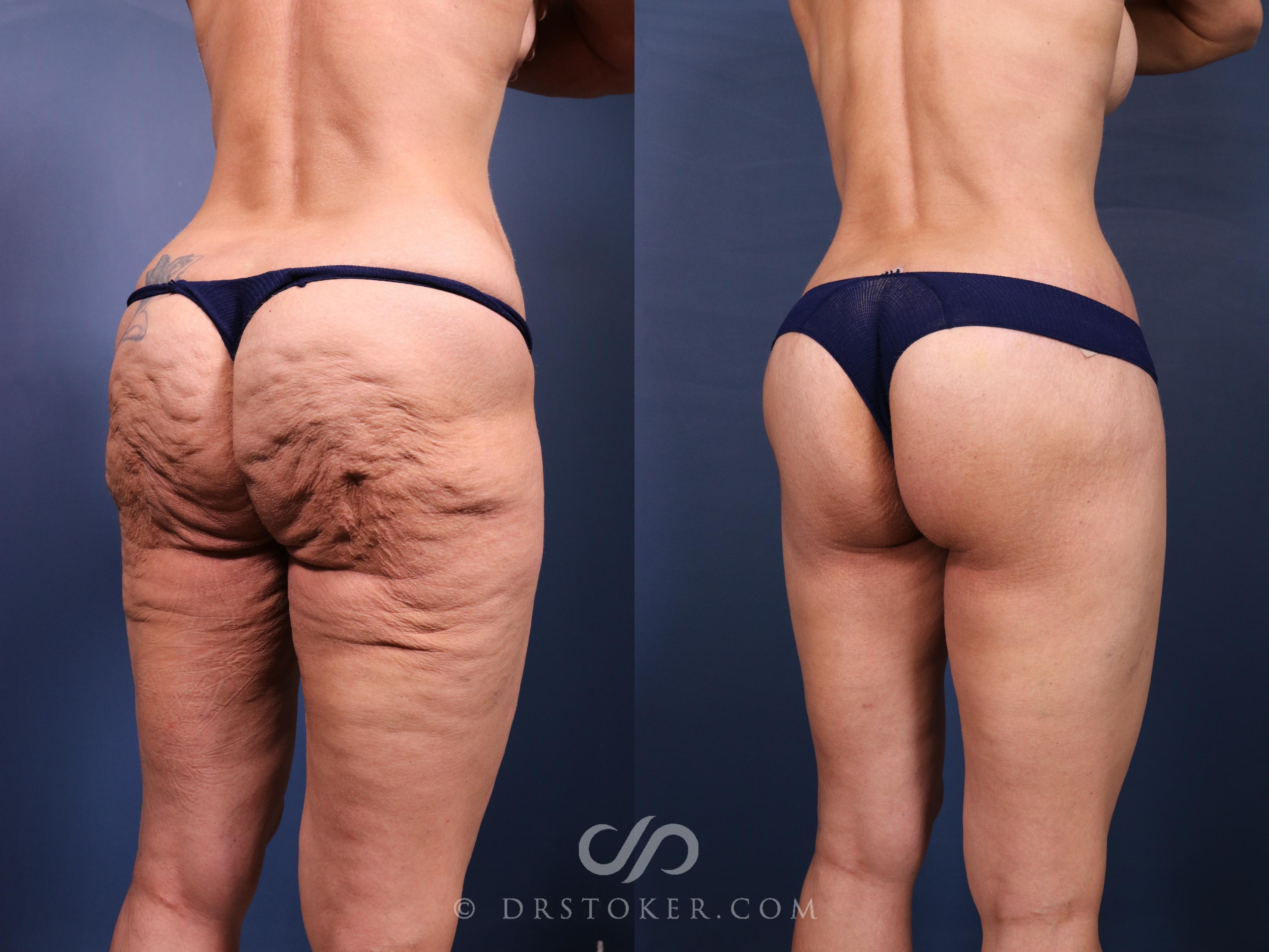 Before & After Bikini Body Lift ™ Case 2551 Right Oblique View in Los Angeles, CA