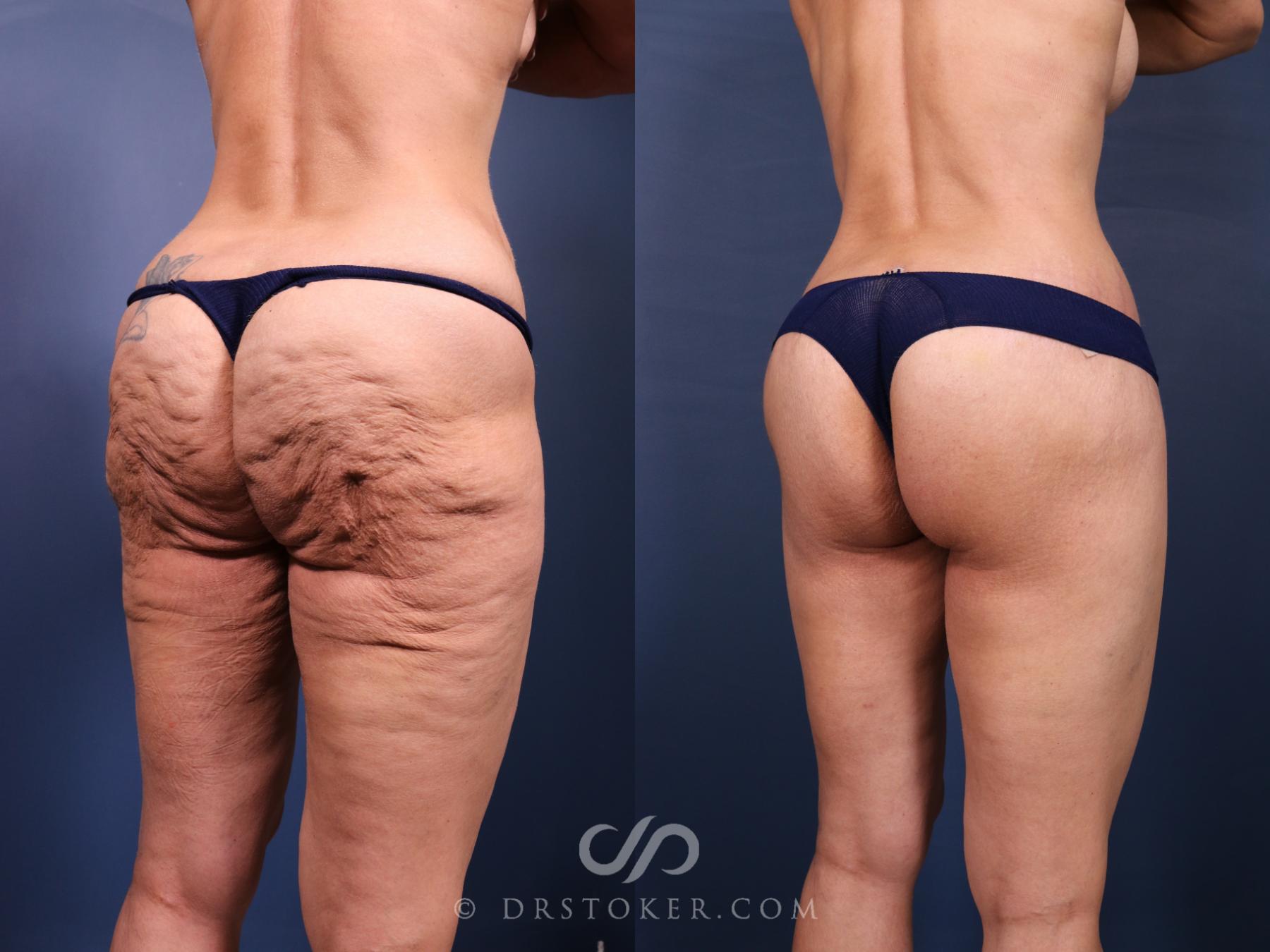 Before & After Bikini Body Lift ™ Case 2551 Right Oblique View in Los Angeles, CA