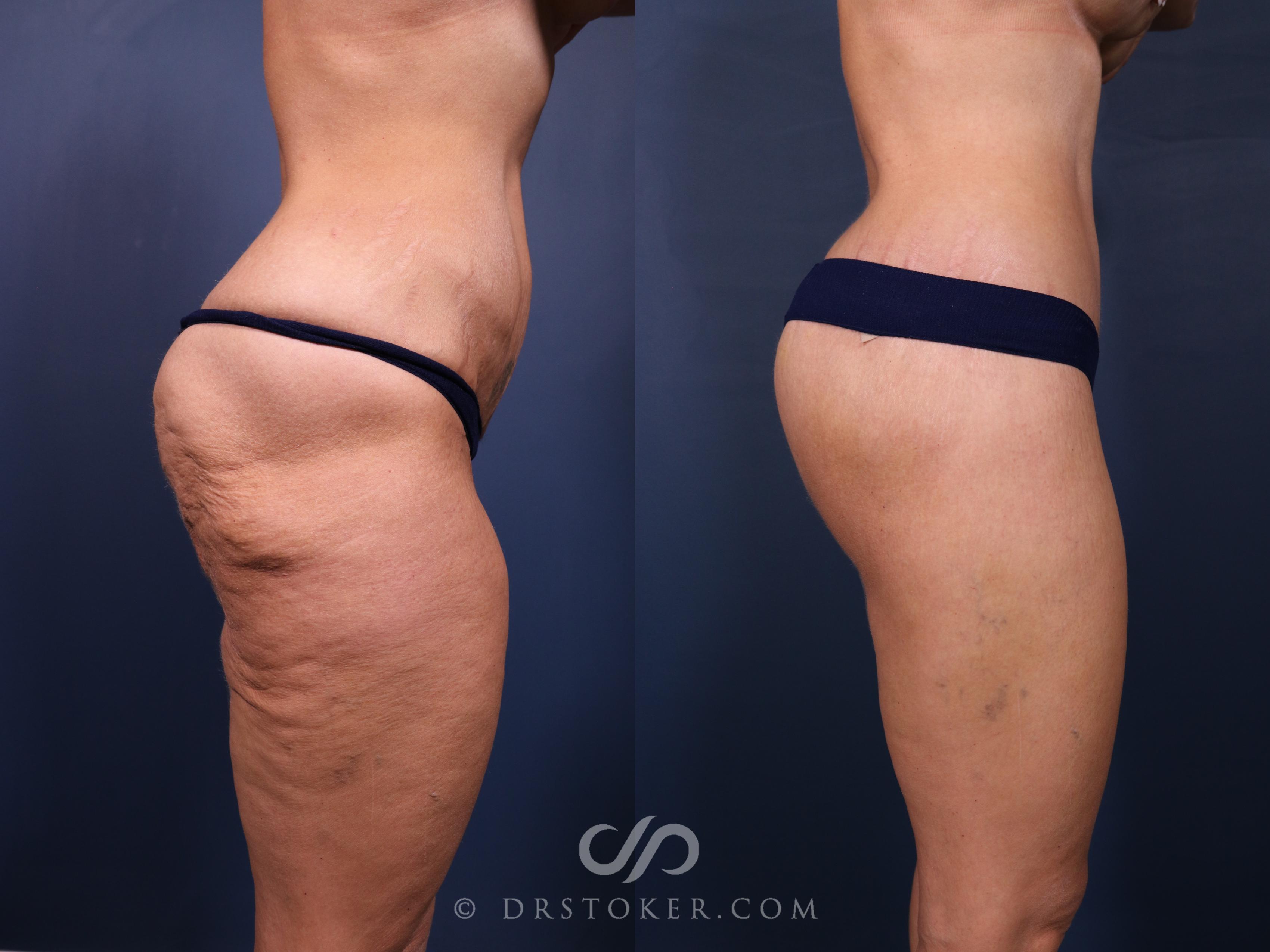 Before & After Bikini Body Lift ™ Case 2551 Right Side View in Los Angeles, CA