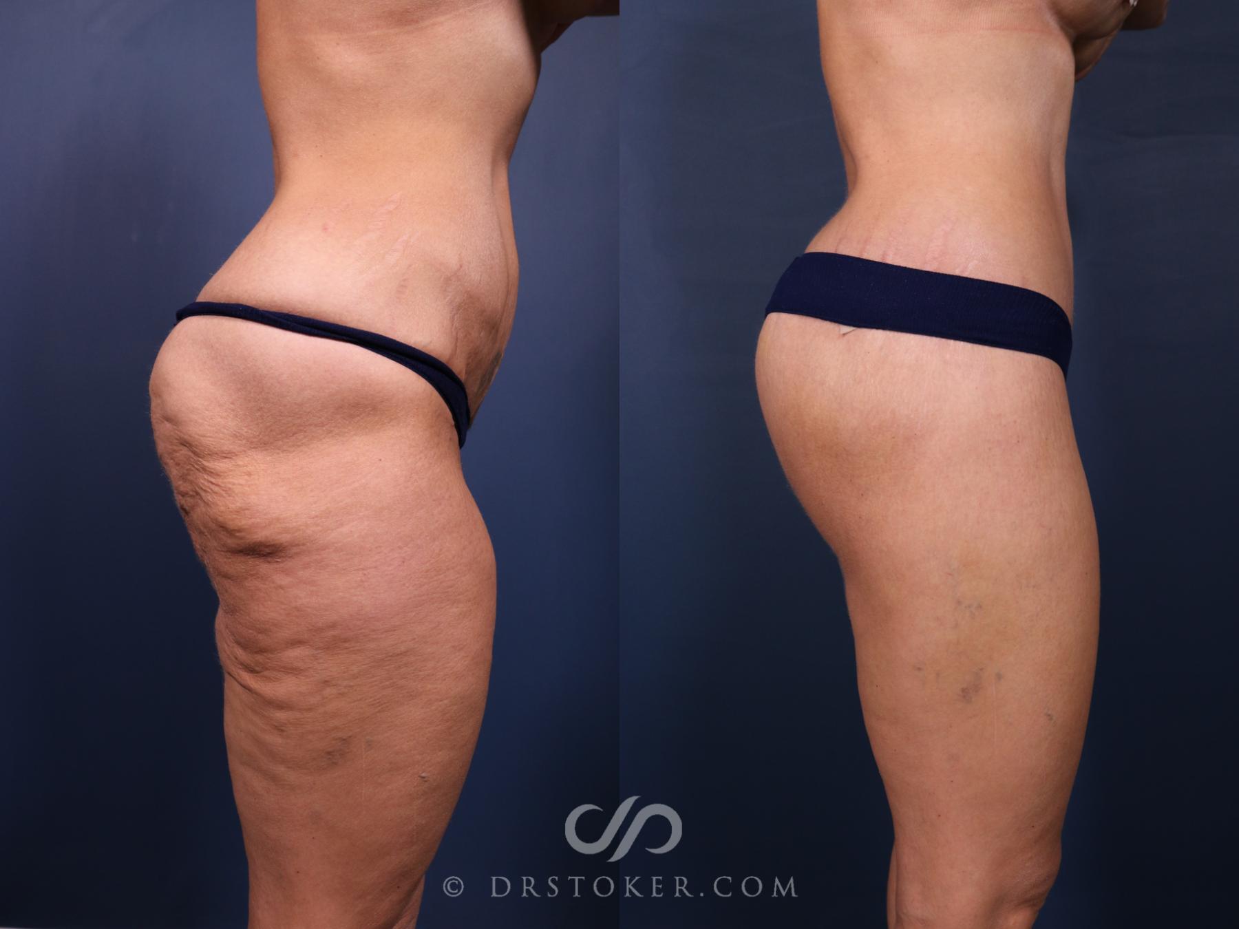 Before & After Bikini Body Lift ™ Case 2551 Right Side View in Los Angeles, CA