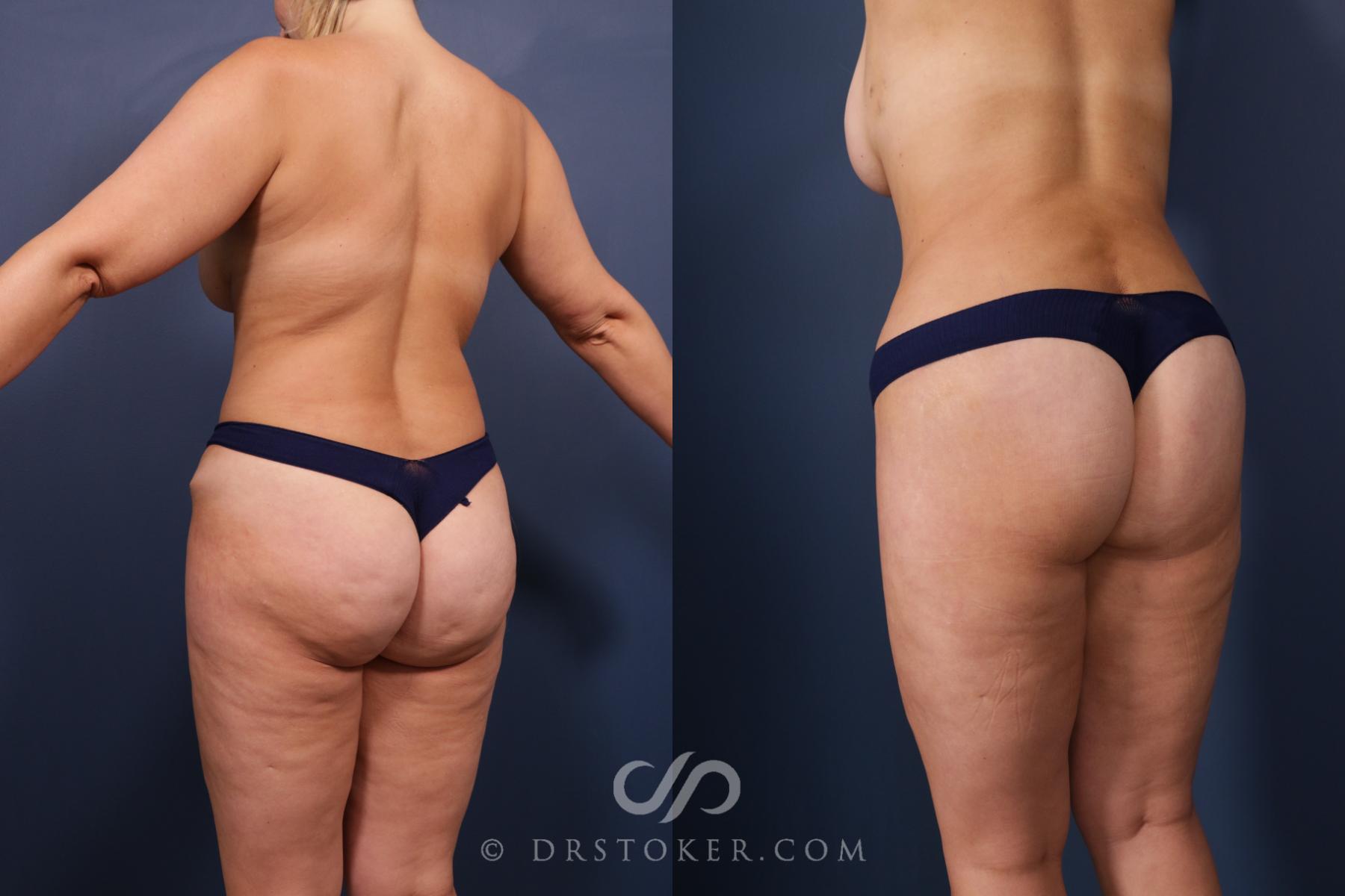 Before & After Bikini Body Lift ™ Case 2555 Left Oblique View in Los Angeles, CA
