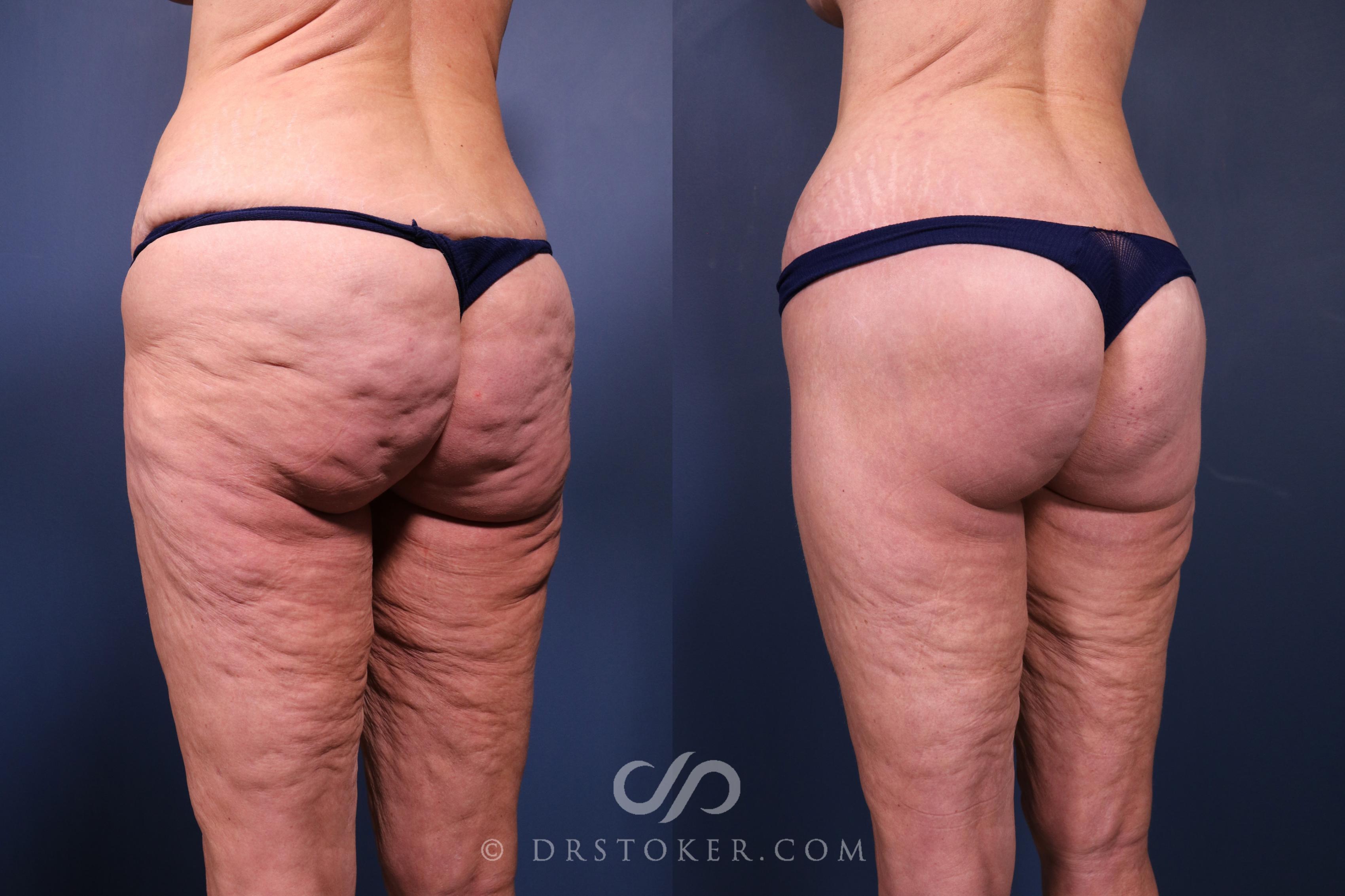 Before & After Bikini Body Lift ™ Case 2557 Left Oblique View in Los Angeles, CA