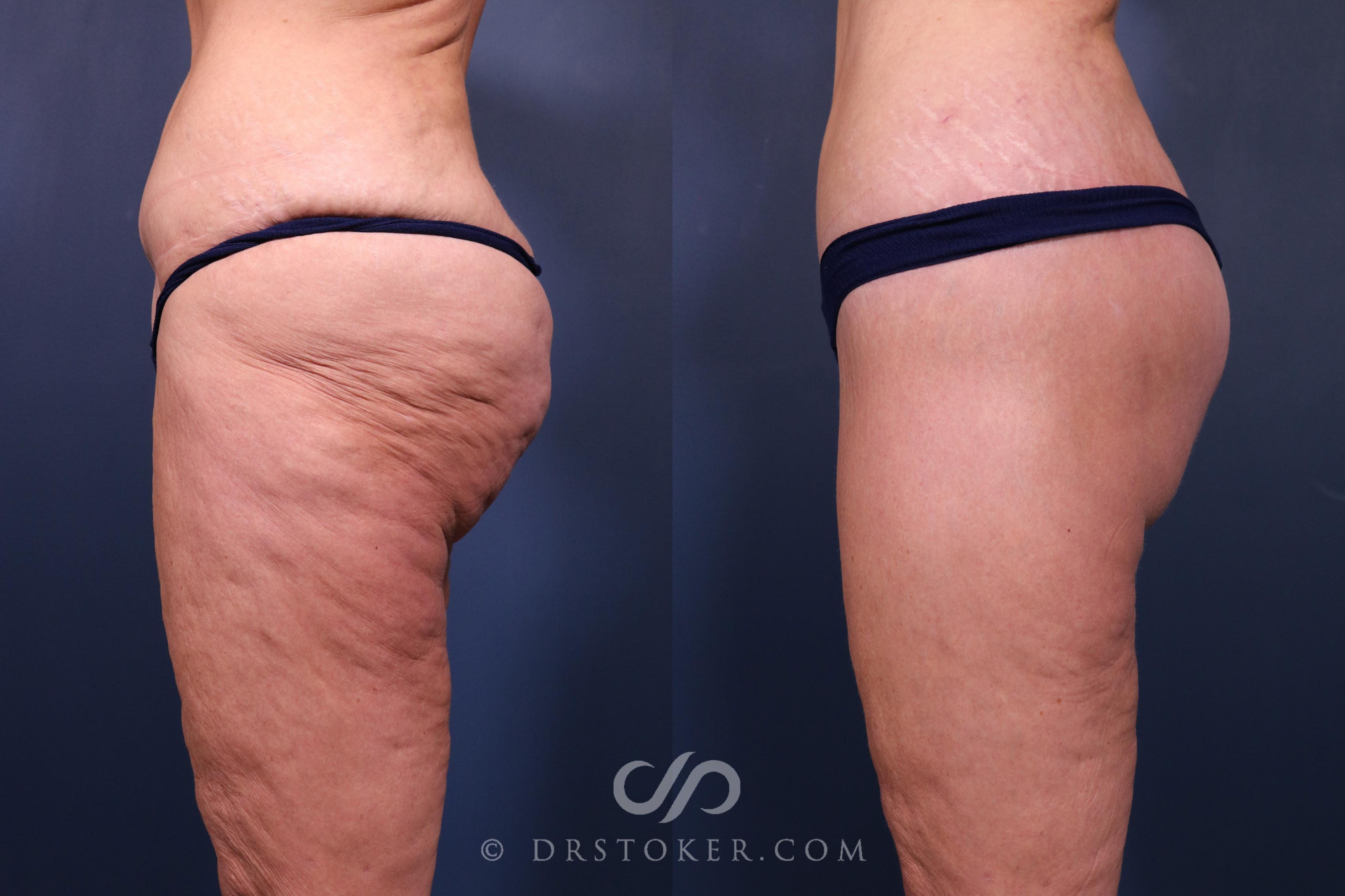 Before & After Bikini Body Lift ™ Case 2557 Left Side View in Los Angeles, CA