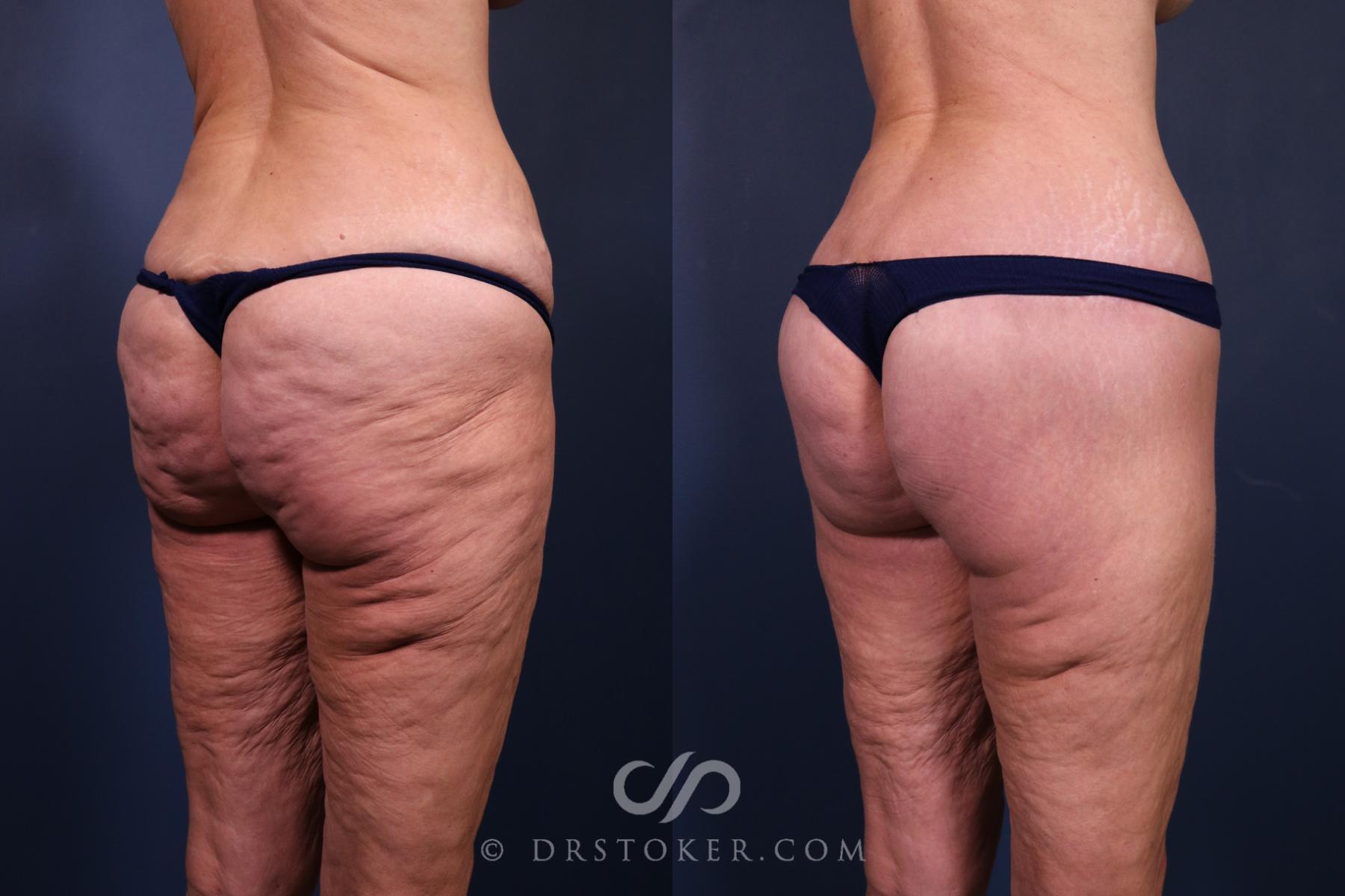 Before & After Bikini Body Lift ™ Case 2557 Right Oblique View in Los Angeles, CA