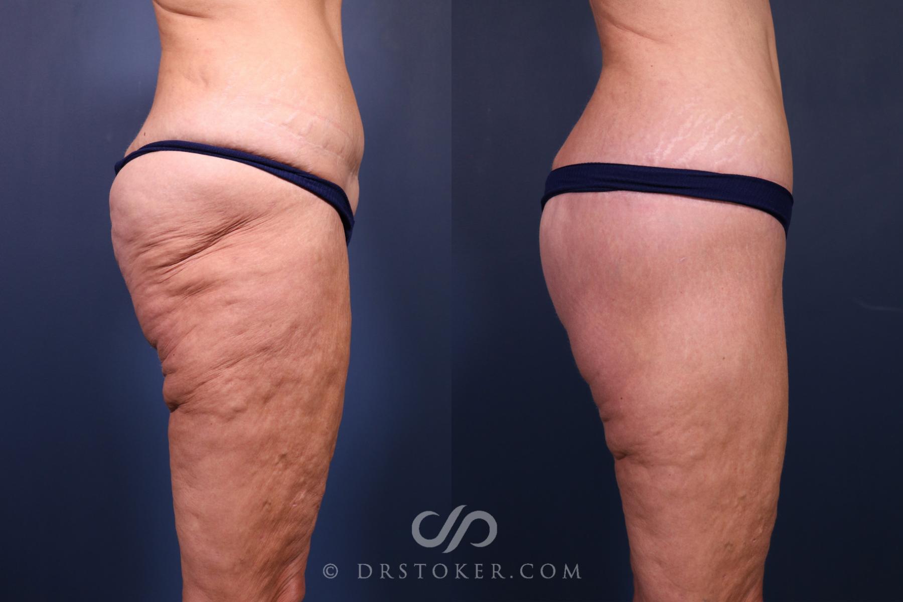 Before & After Bikini Body Lift ™ Case 2557 Right Side View in Los Angeles, CA