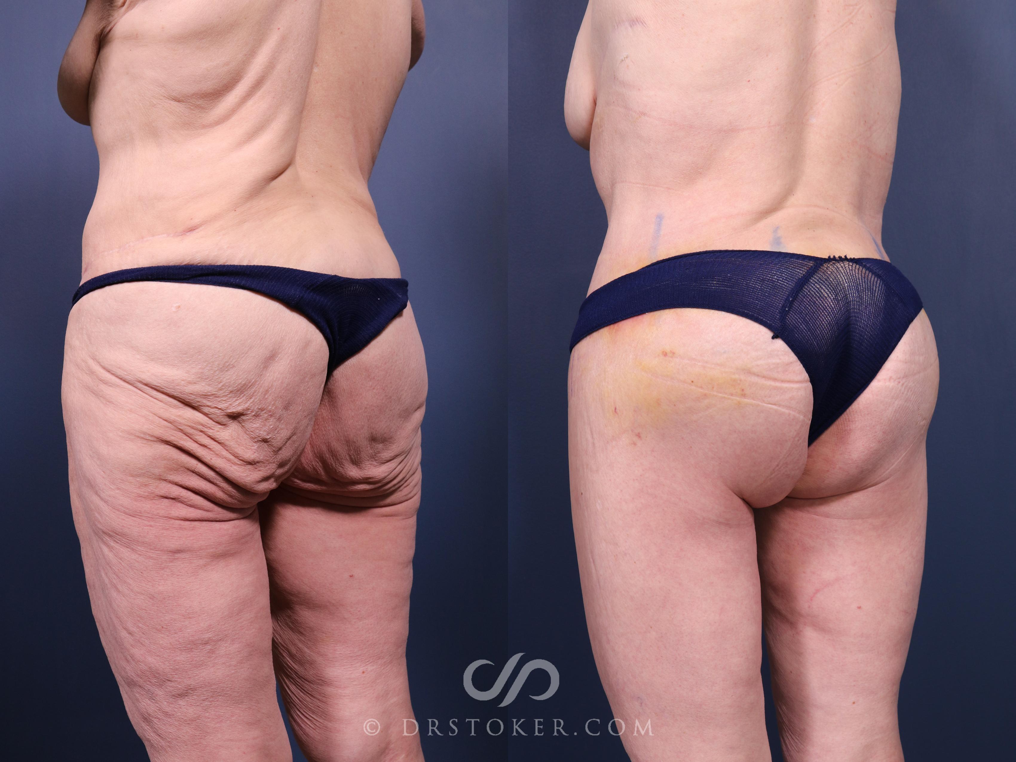 Before & After Bikini Body Lift Case 2382 Left Oblique View in Los Angeles, CA