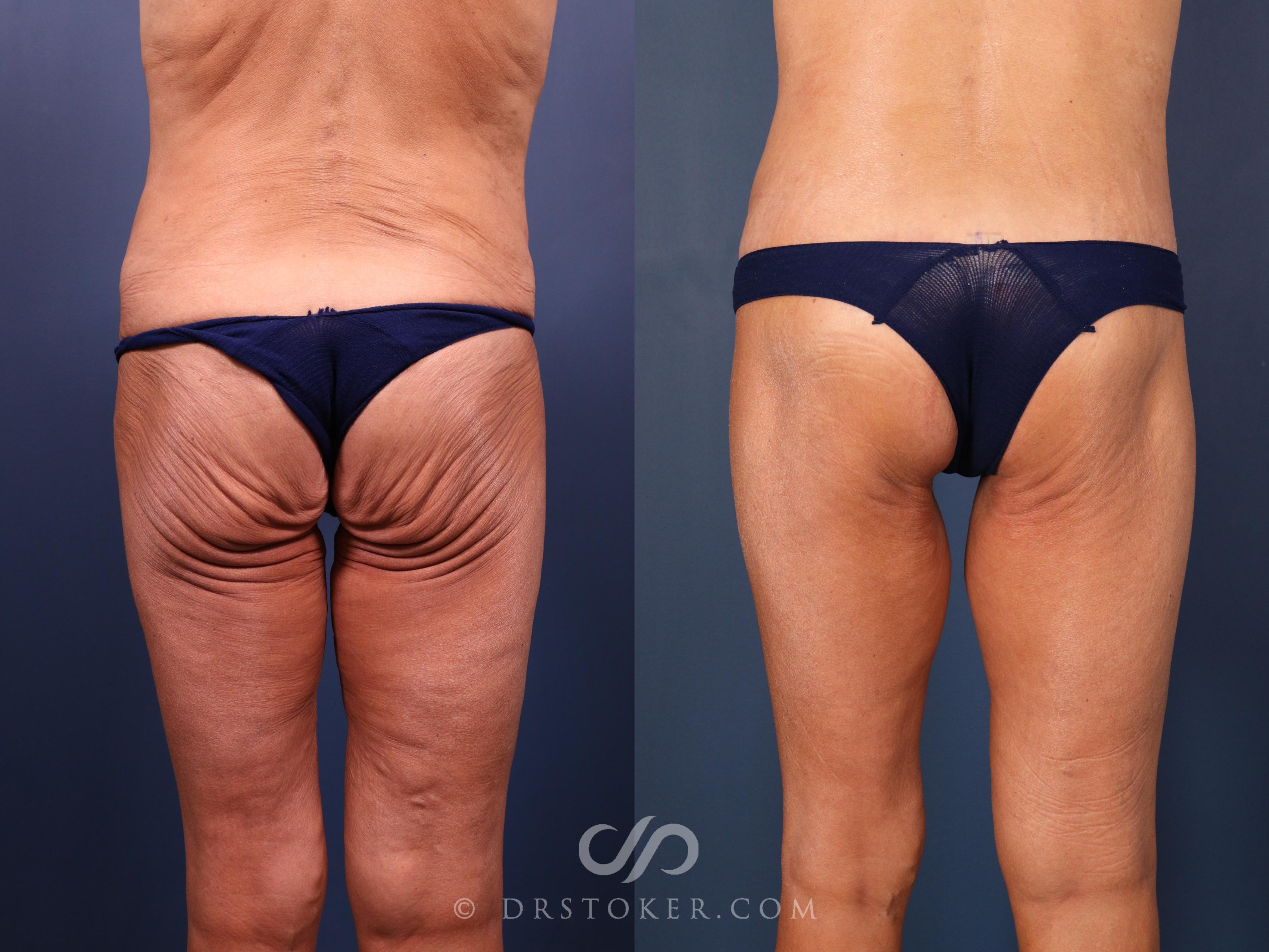 Before & After Bikini Body Lift Case 2386 Back View in Los Angeles, CA
