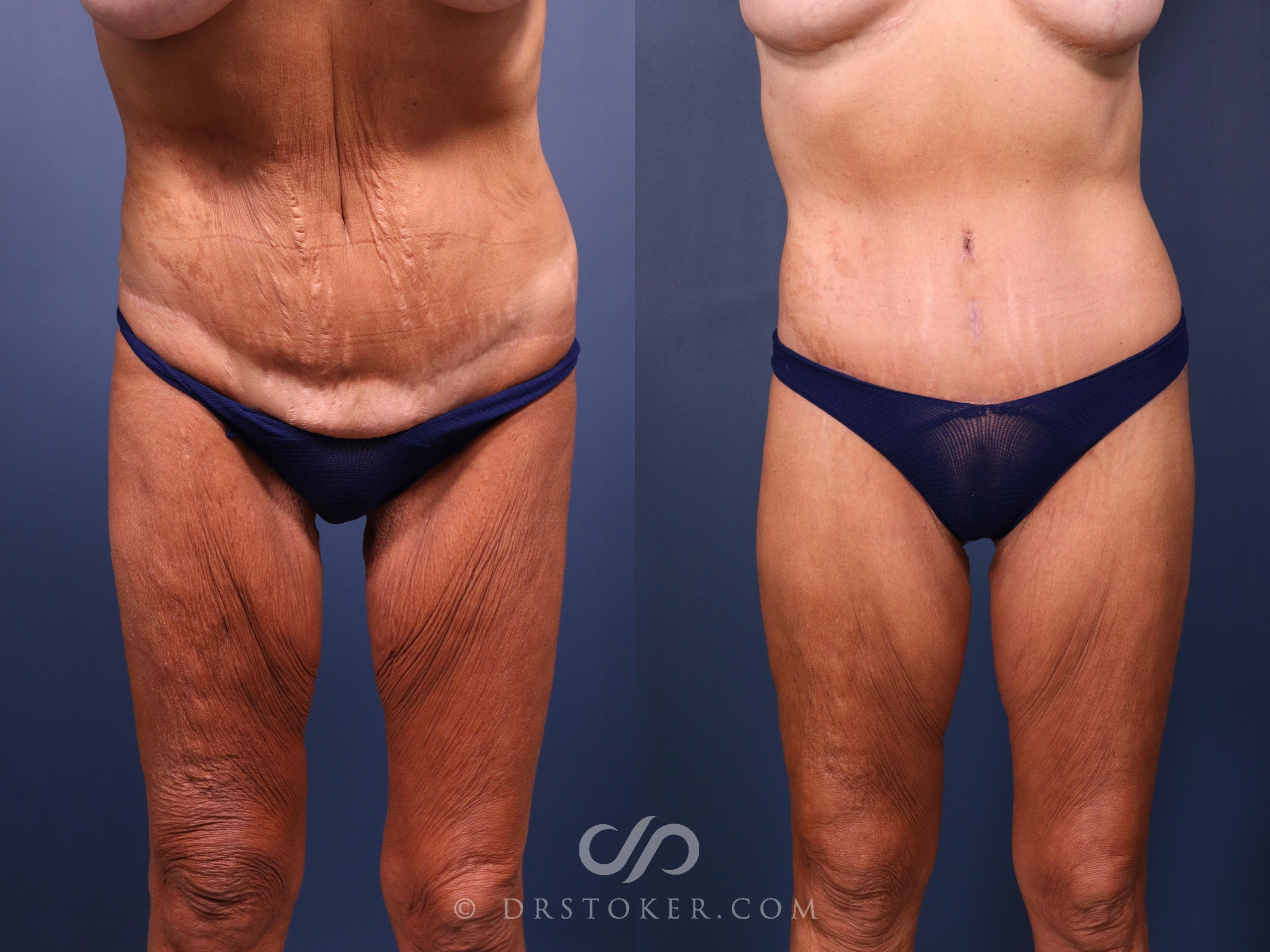 Before & After Bikini Body Lift Case 2386 Front View in Los Angeles, CA