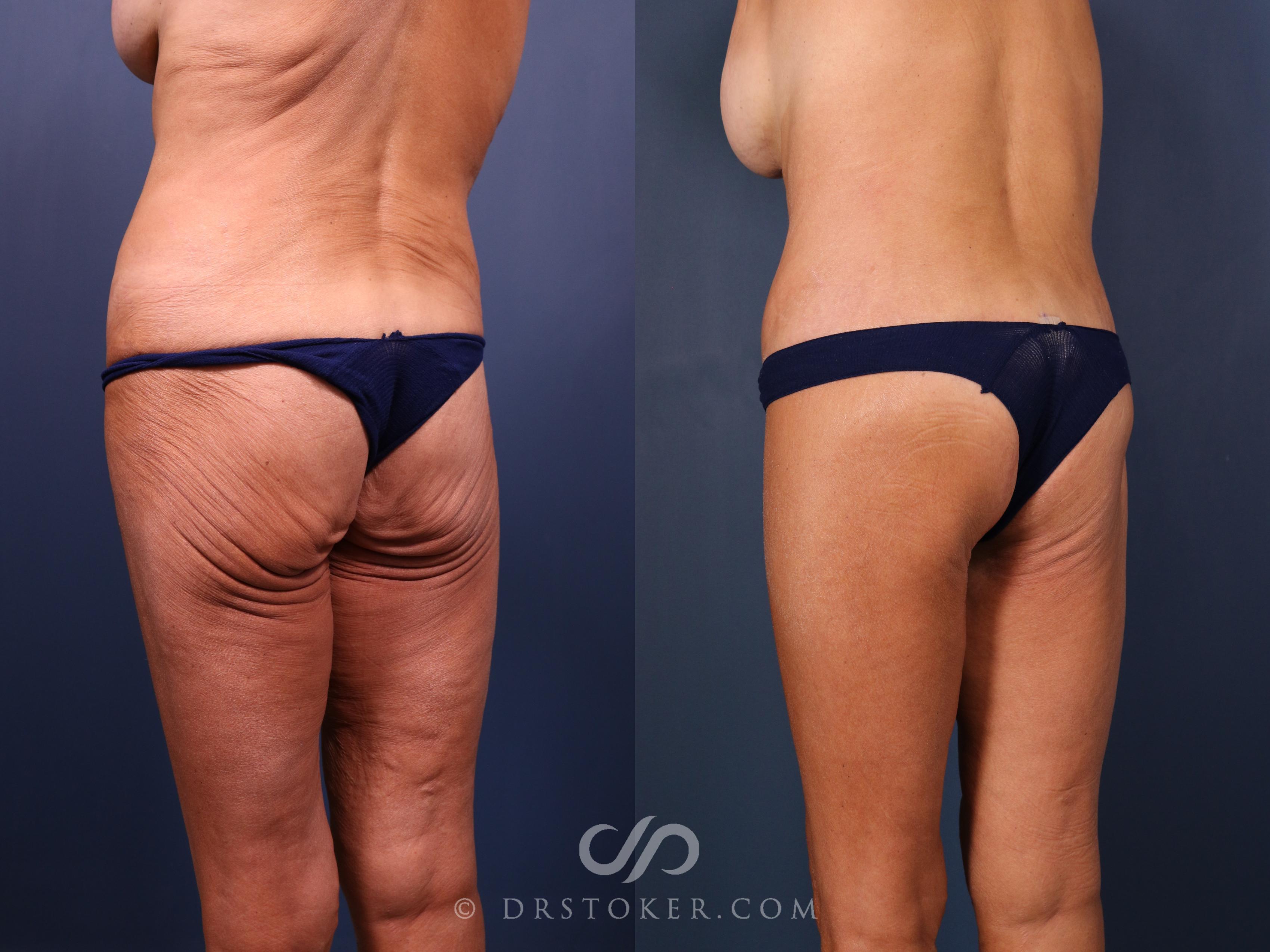 Before & After Bikini Body Lift Case 2386 Left Oblique View in Los Angeles, CA