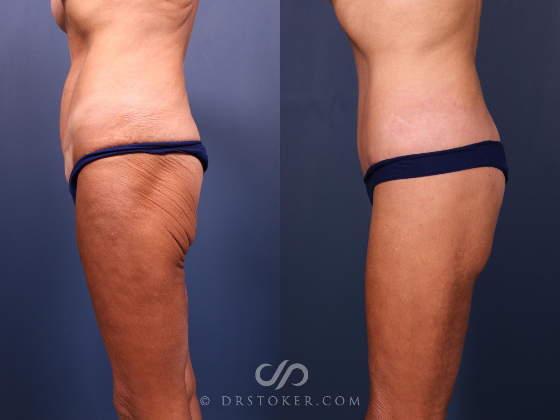 Before & After Bikini Body Lift Case 2386 Left Side View in Los Angeles, CA