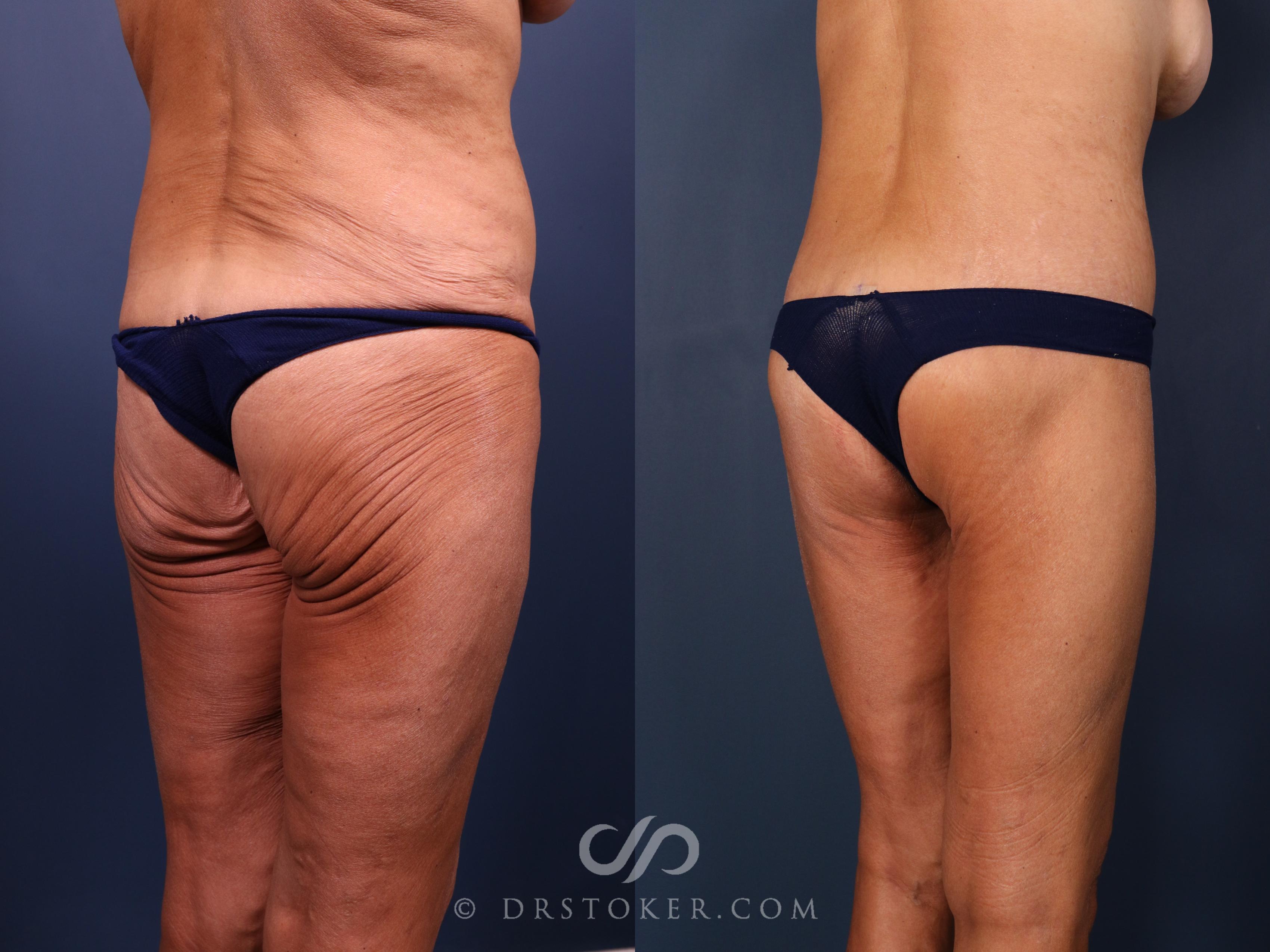 Before & After Bikini Body Lift Case 2386 Right Oblique View in Los Angeles, CA