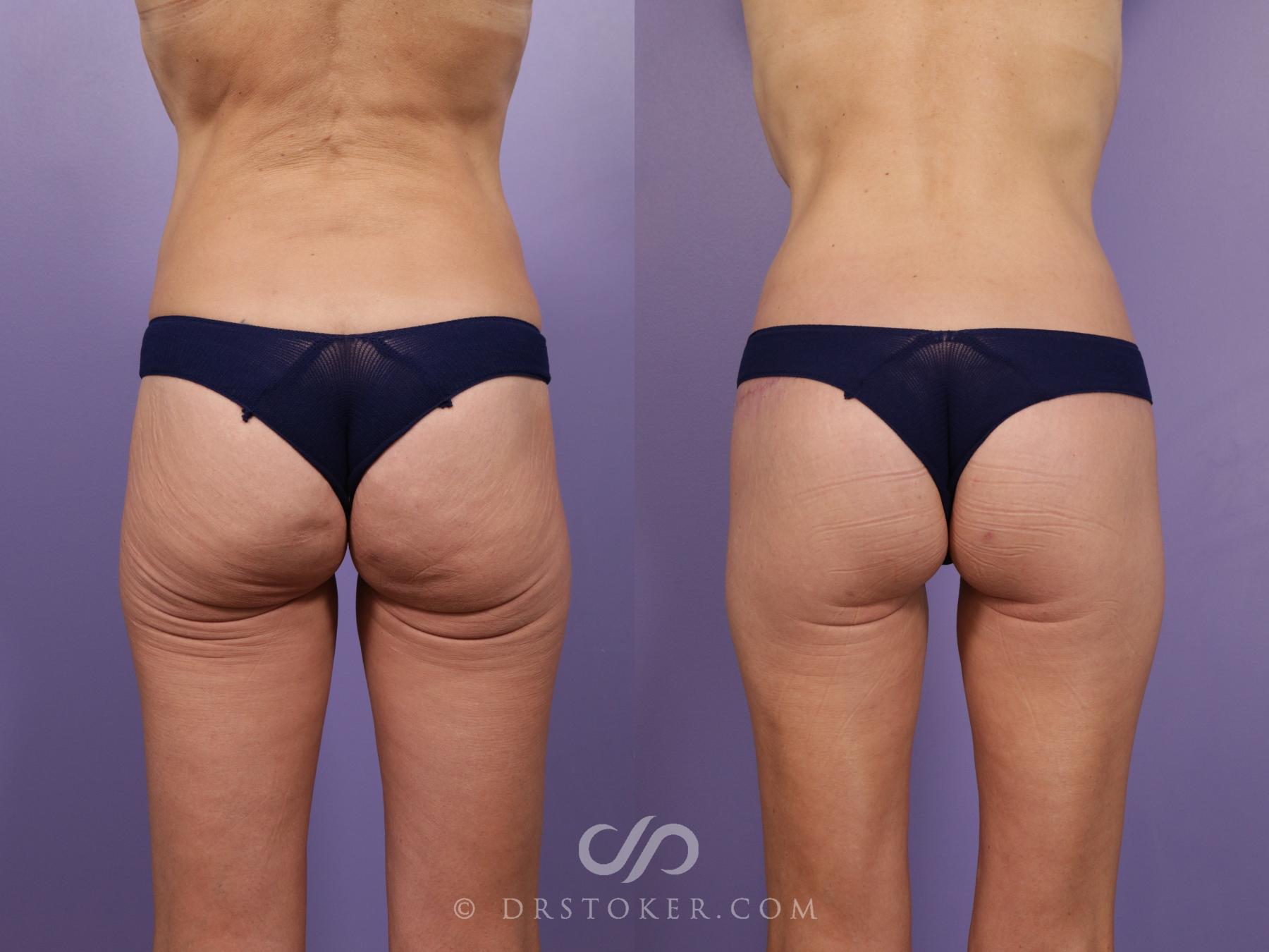Before & After Bikini Body Lift Case 2388 Back View in Los Angeles, CA