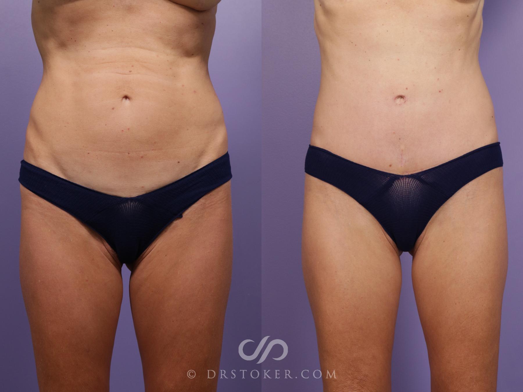 Before & After Bikini Body Lift Case 2388 Front View in Los Angeles, CA