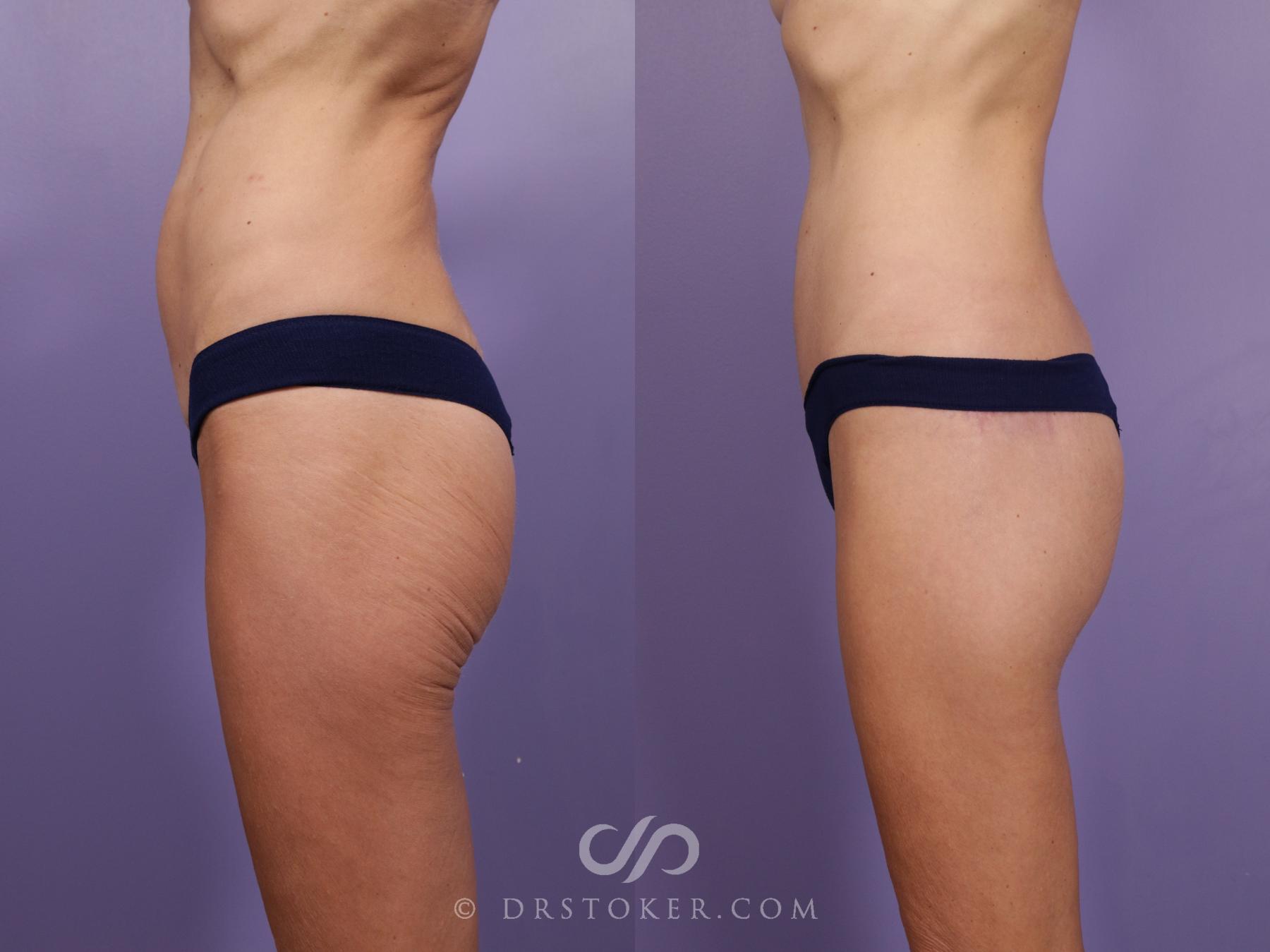Before & After Bikini Body Lift Case 2388 Left Side View in Los Angeles, CA