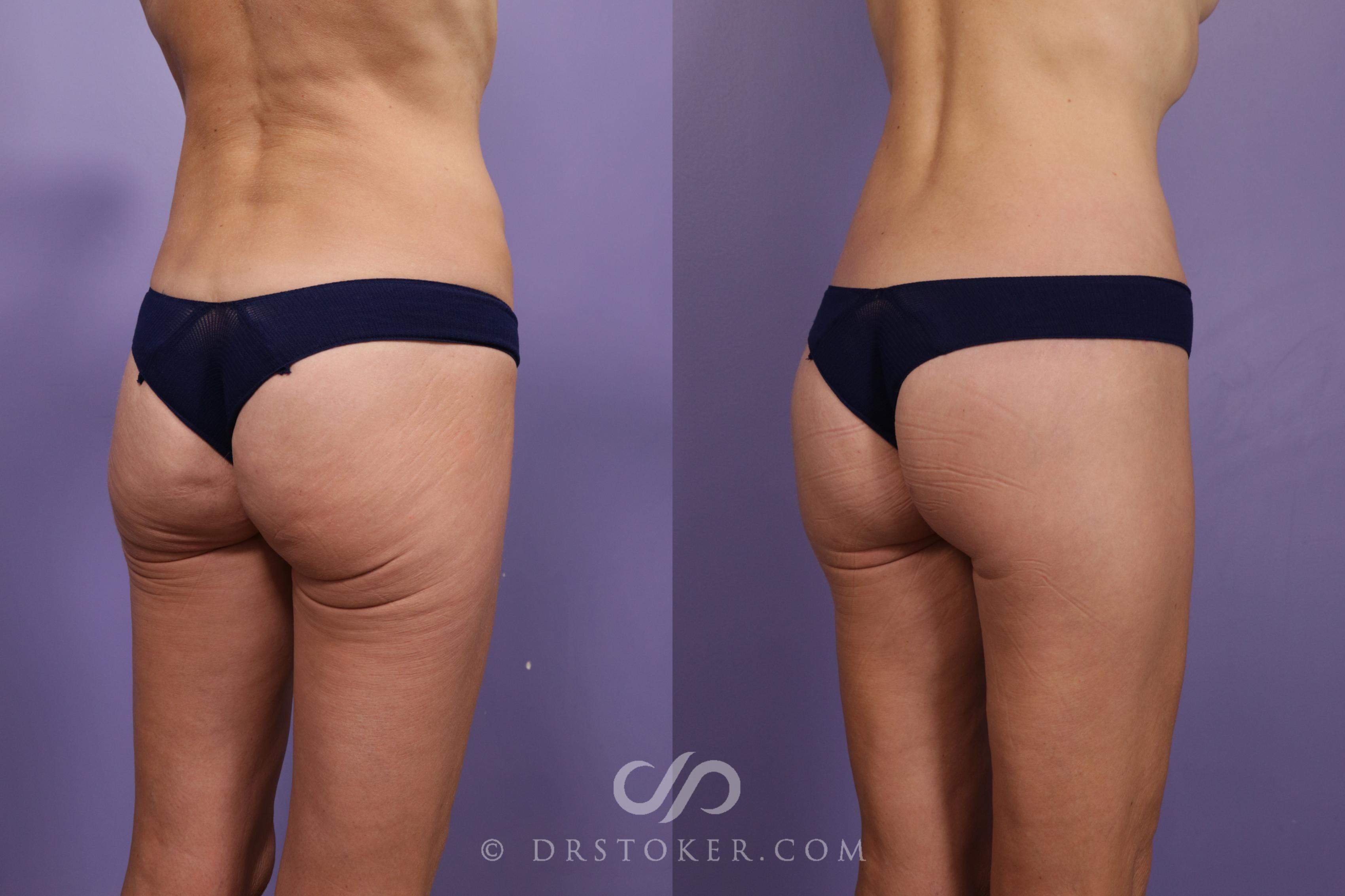 Before & After Bikini Body Lift Case 2388 Right Oblique View in Los Angeles, CA