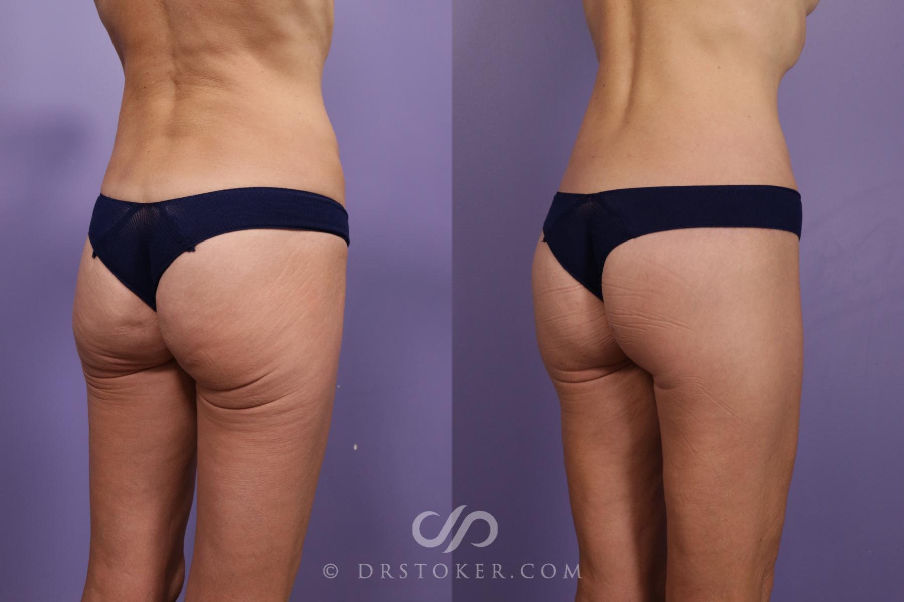 Before & After Bikini Body Lift Case 2388 Right Oblique View in Los Angeles, CA