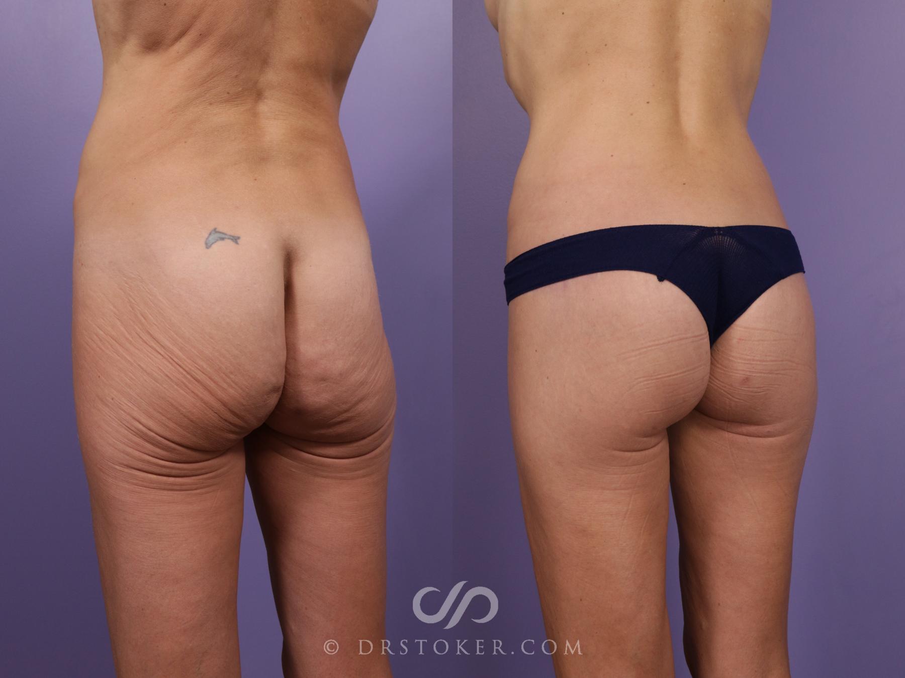 Before & After Bikini Body Lift Case 2389 Left Oblique View in Los Angeles, CA