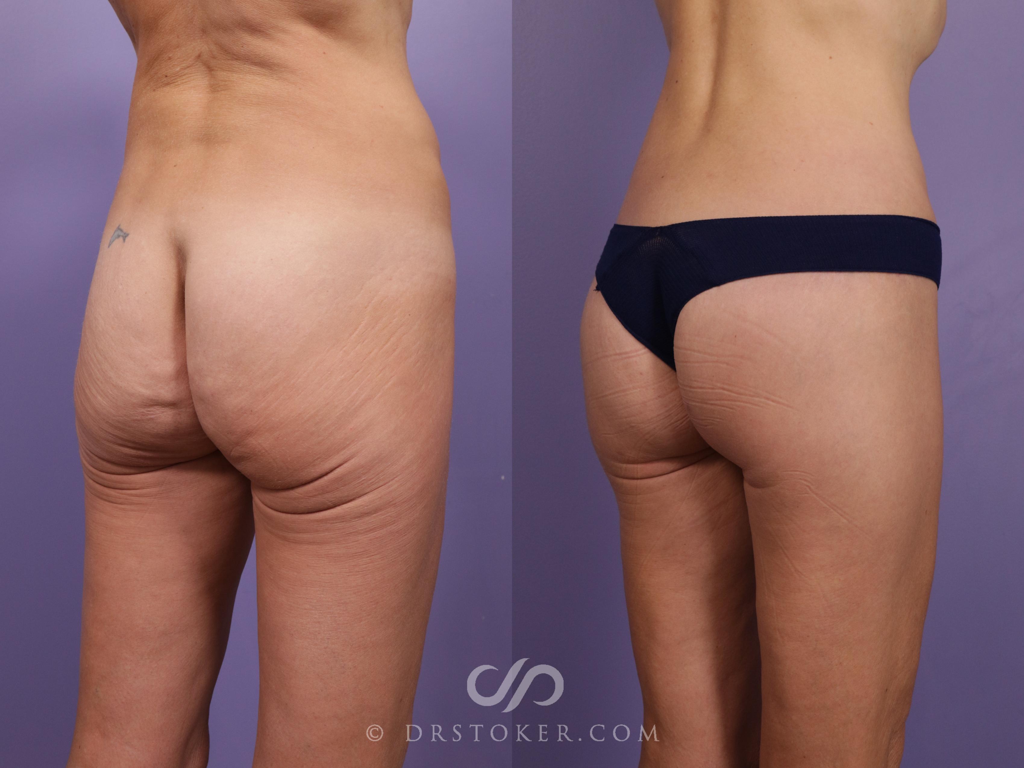 Before & After Bikini Body Lift Case 2389 Right Oblique View in Los Angeles, CA