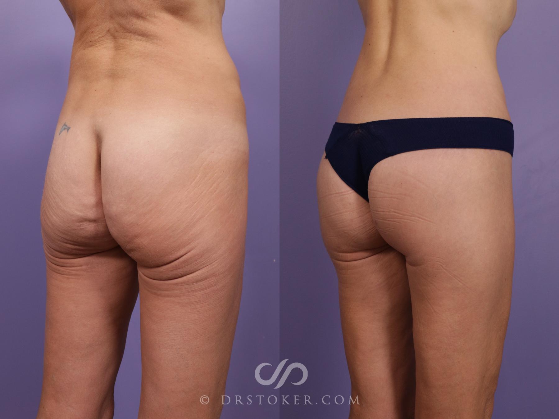 Before & After Bikini Body Lift Case 2389 Right Oblique View in Los Angeles, CA