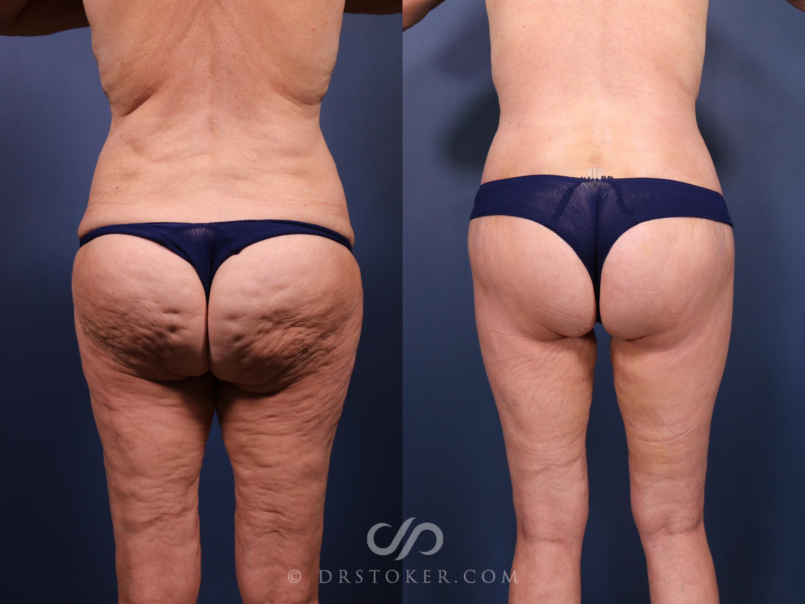 Before & After Bikini Body Lift Case 2392 Back View in Los Angeles, CA