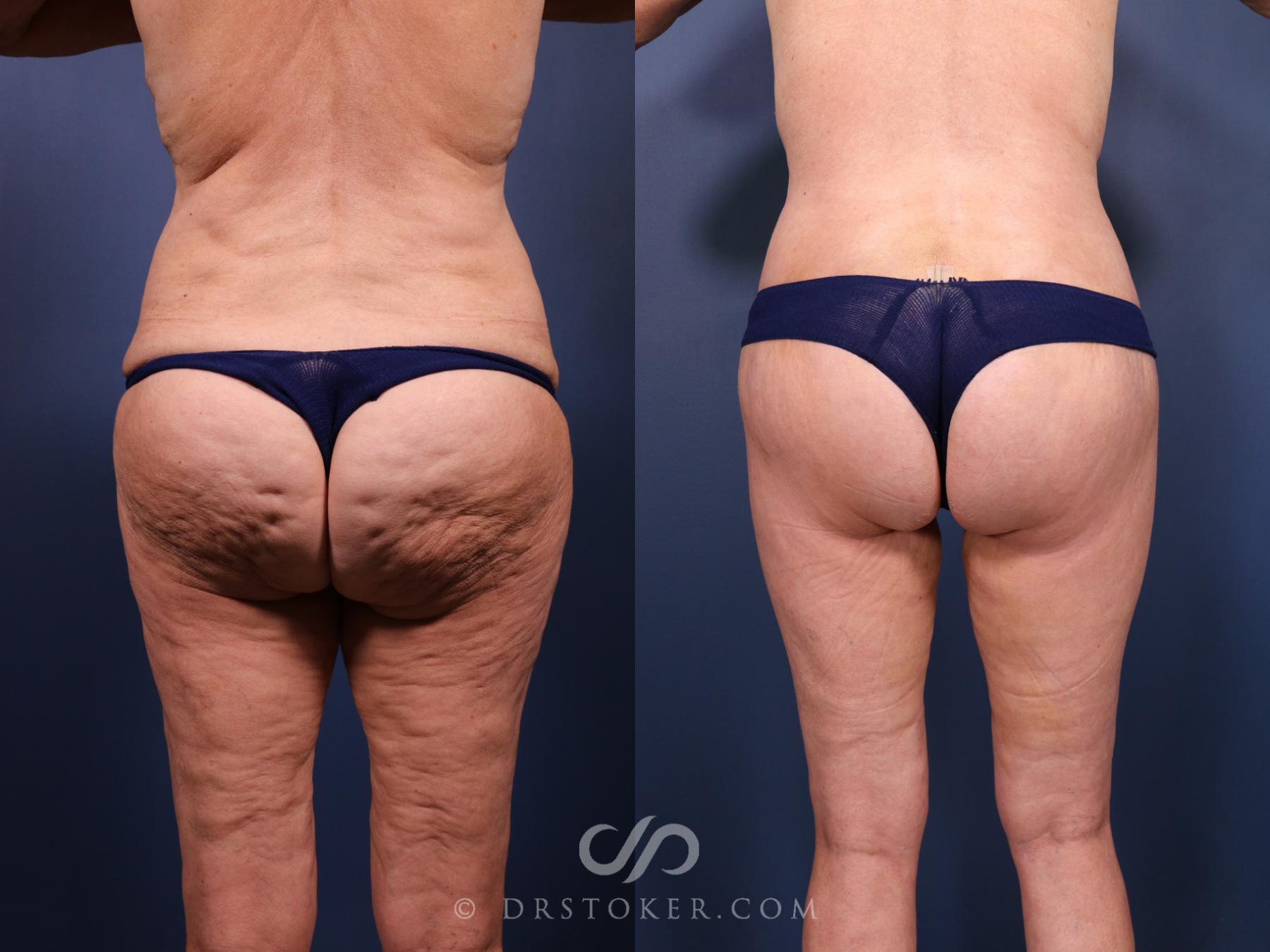Before & After Bikini Body Lift Case 2392 Back View in Los Angeles, CA