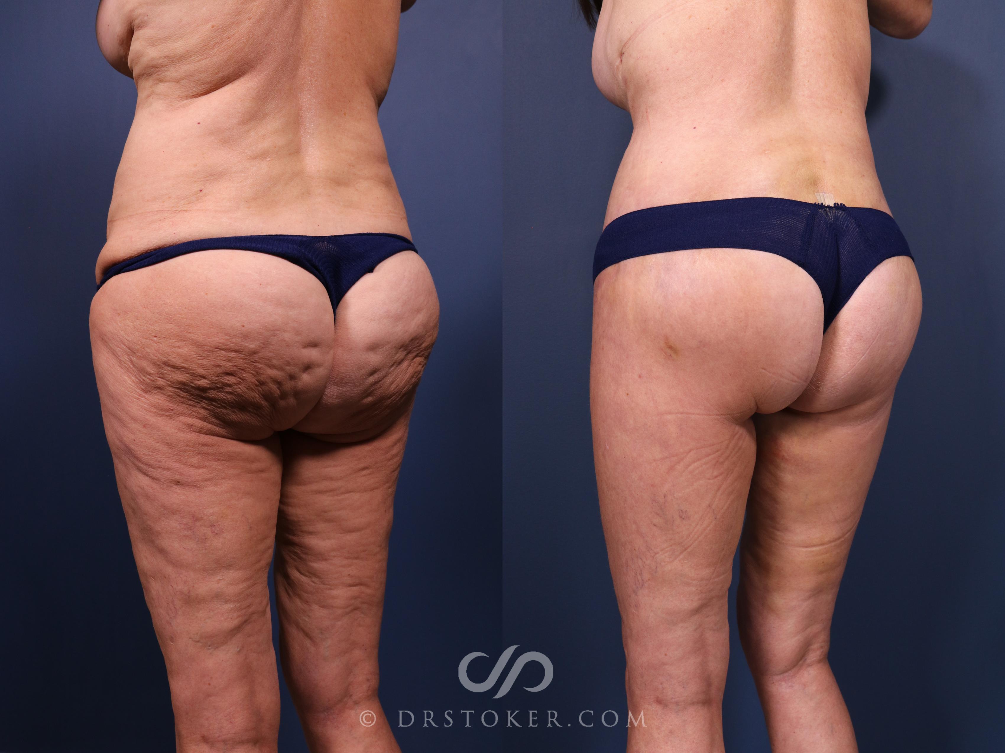 Before & After Bikini Body Lift Case 2392 Left Oblique View in Los Angeles, CA