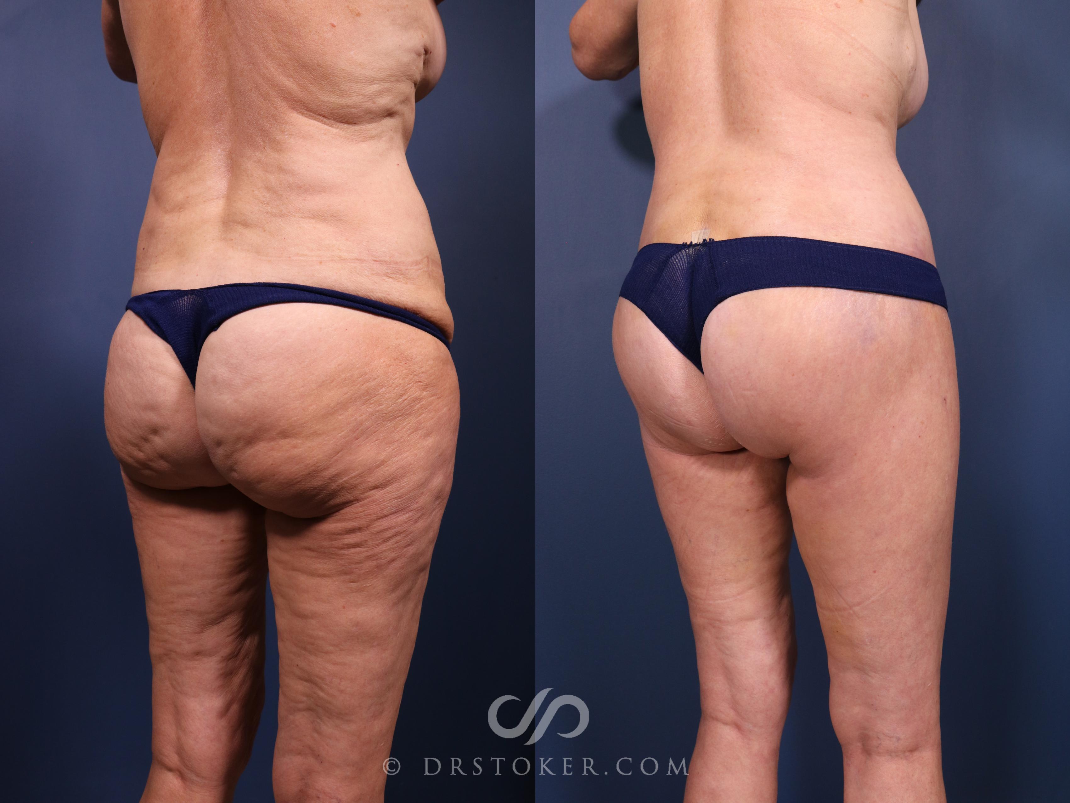 Before & After Bikini Body Lift Case 2392 Right Oblique View in Los Angeles, CA