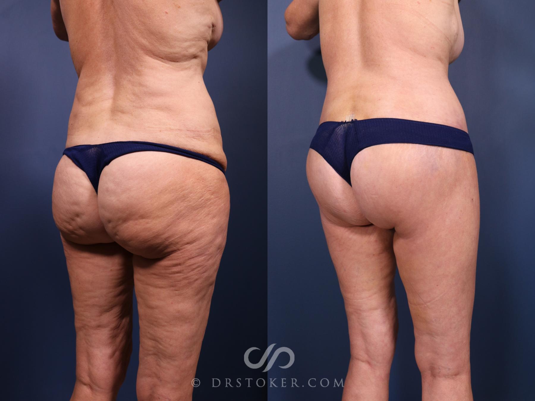 Before & After Bikini Body Lift Case 2392 Right Oblique View in Los Angeles, CA